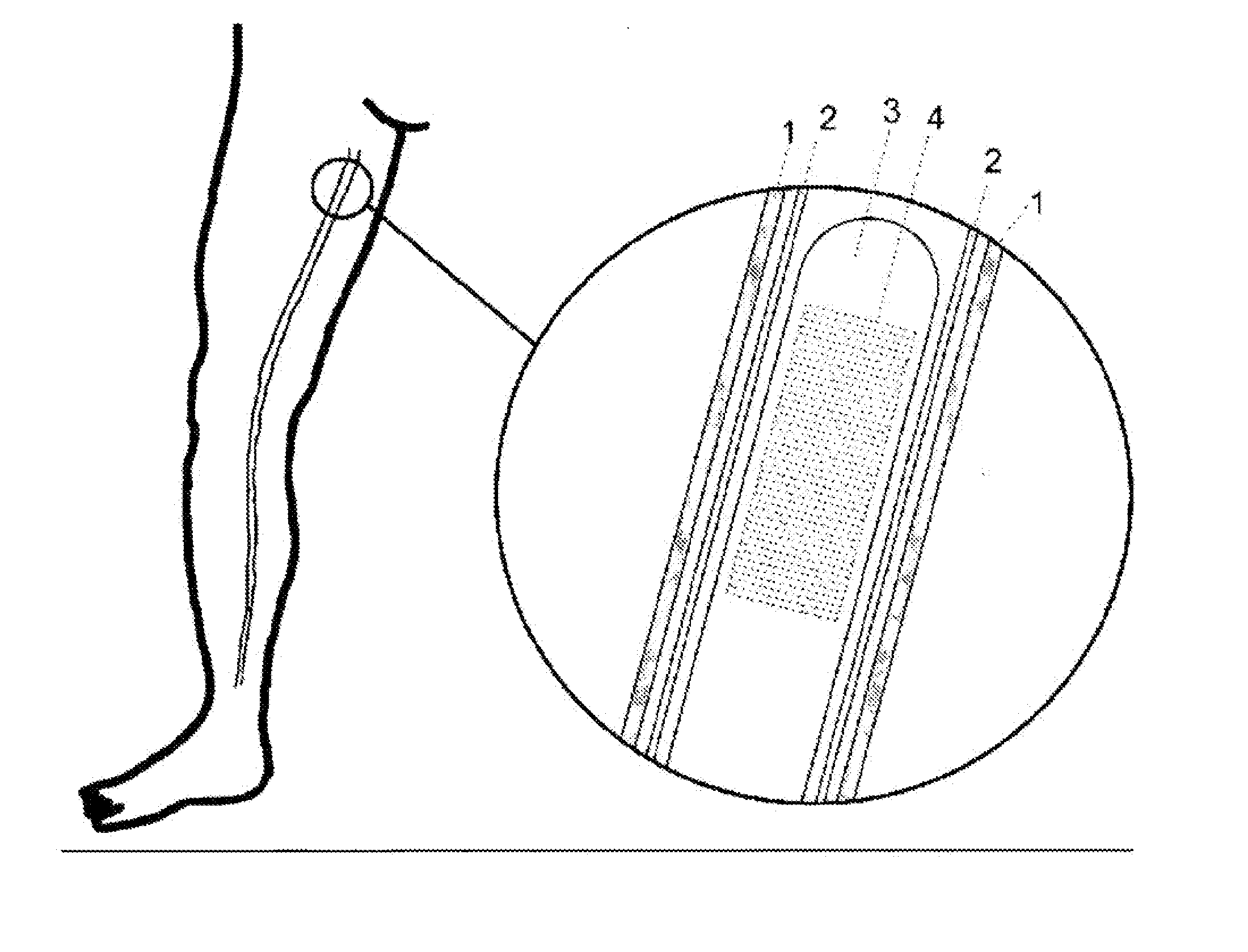 Light-Based Method for the Endovascular Treatment of Pathologically Altered Blood Vessels