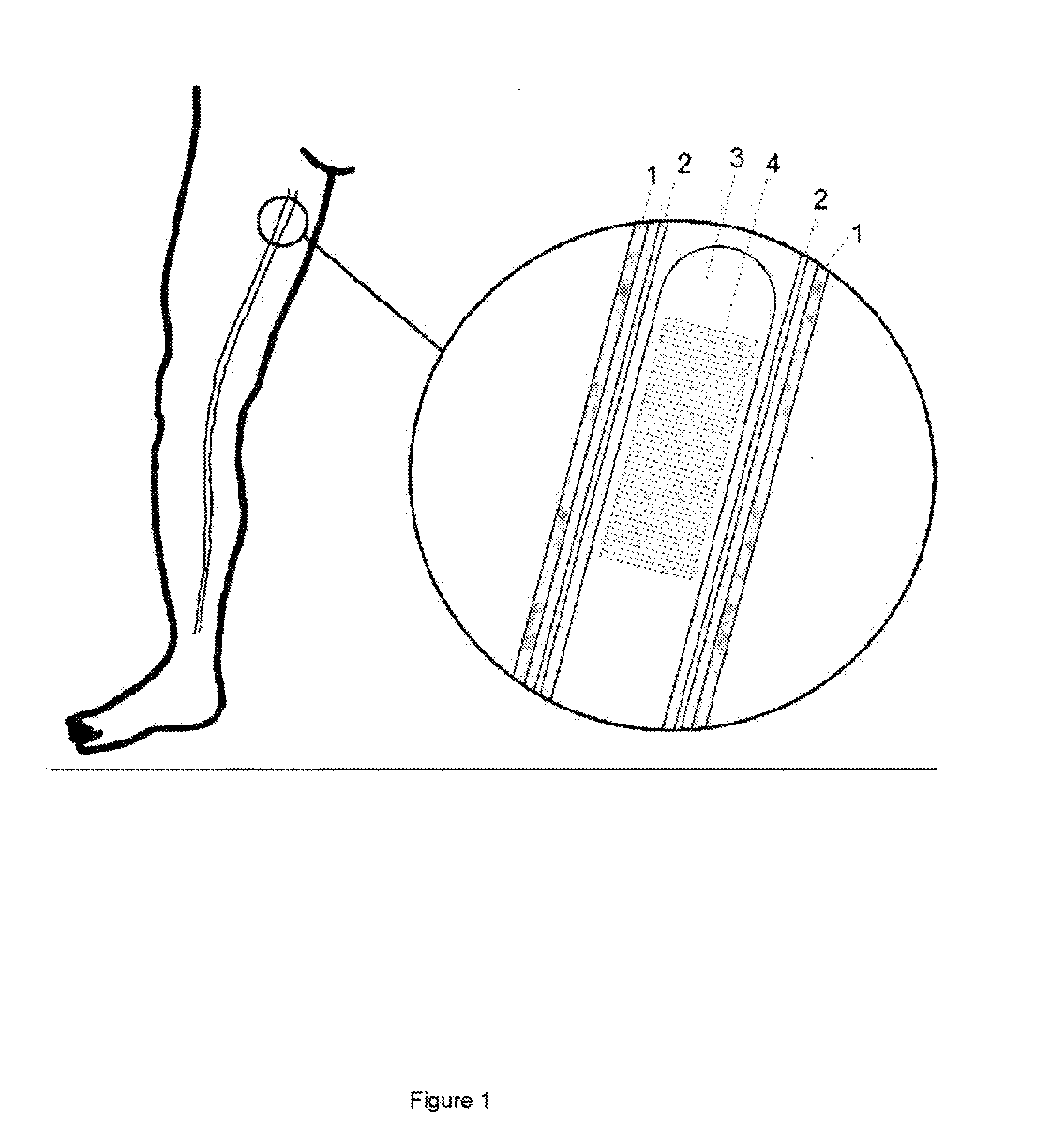 Light-Based Method for the Endovascular Treatment of Pathologically Altered Blood Vessels