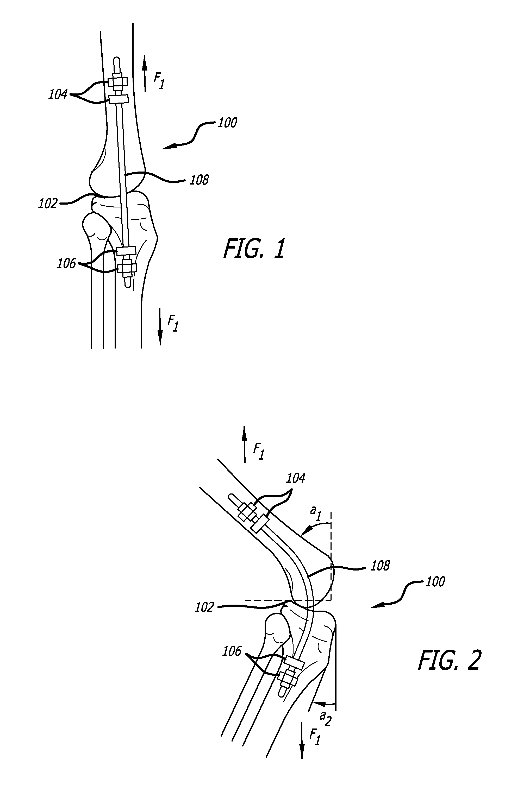 Extra-Articular Implantable Load Sharing Systems