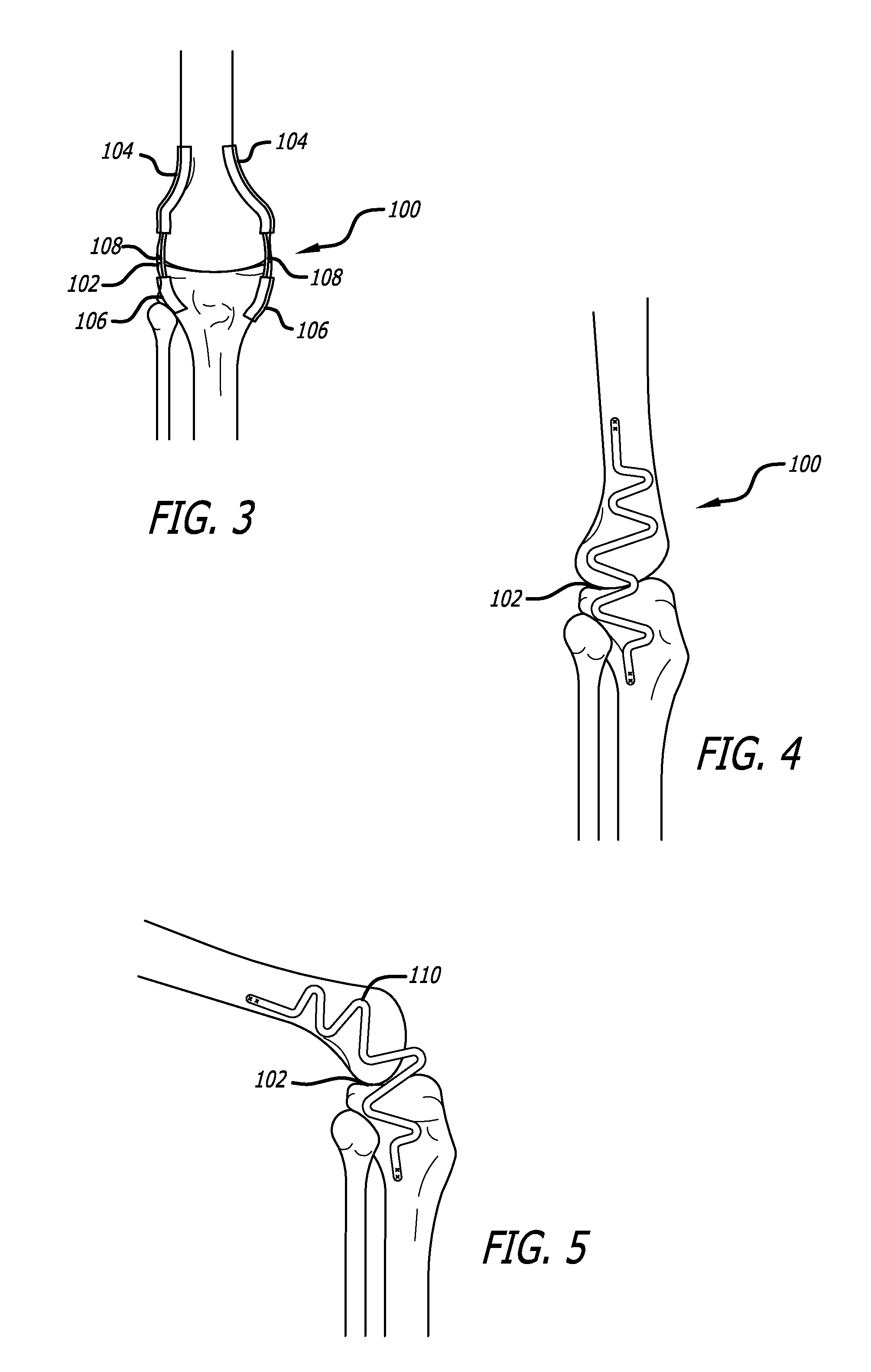 Extra-Articular Implantable Load Sharing Systems