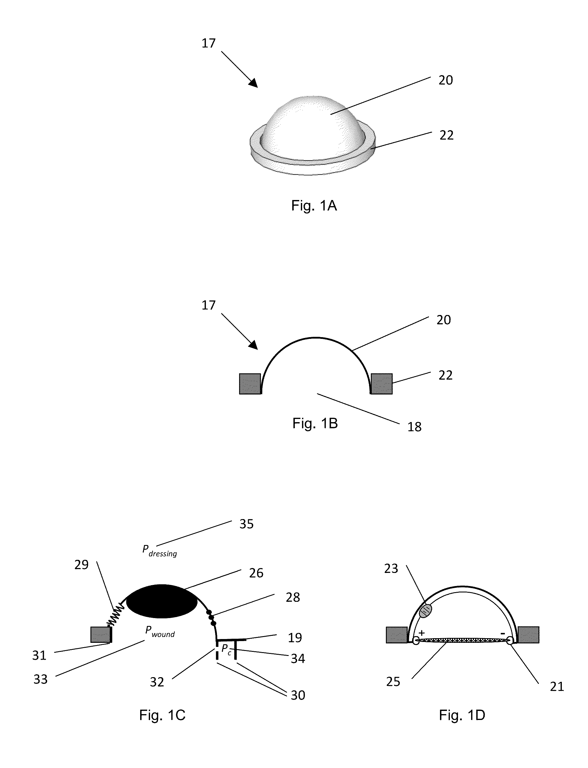 Devices and methods for treatment of fistulas and complex wounds