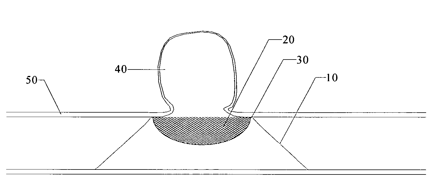 Endovascular aneurysm treatment device and delivery system