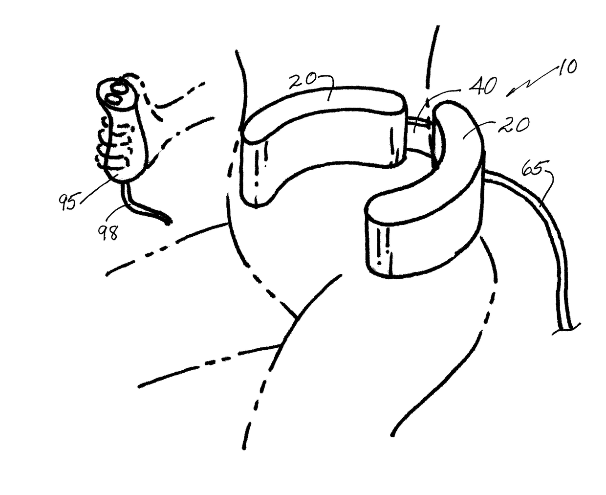 Birth ease method and device