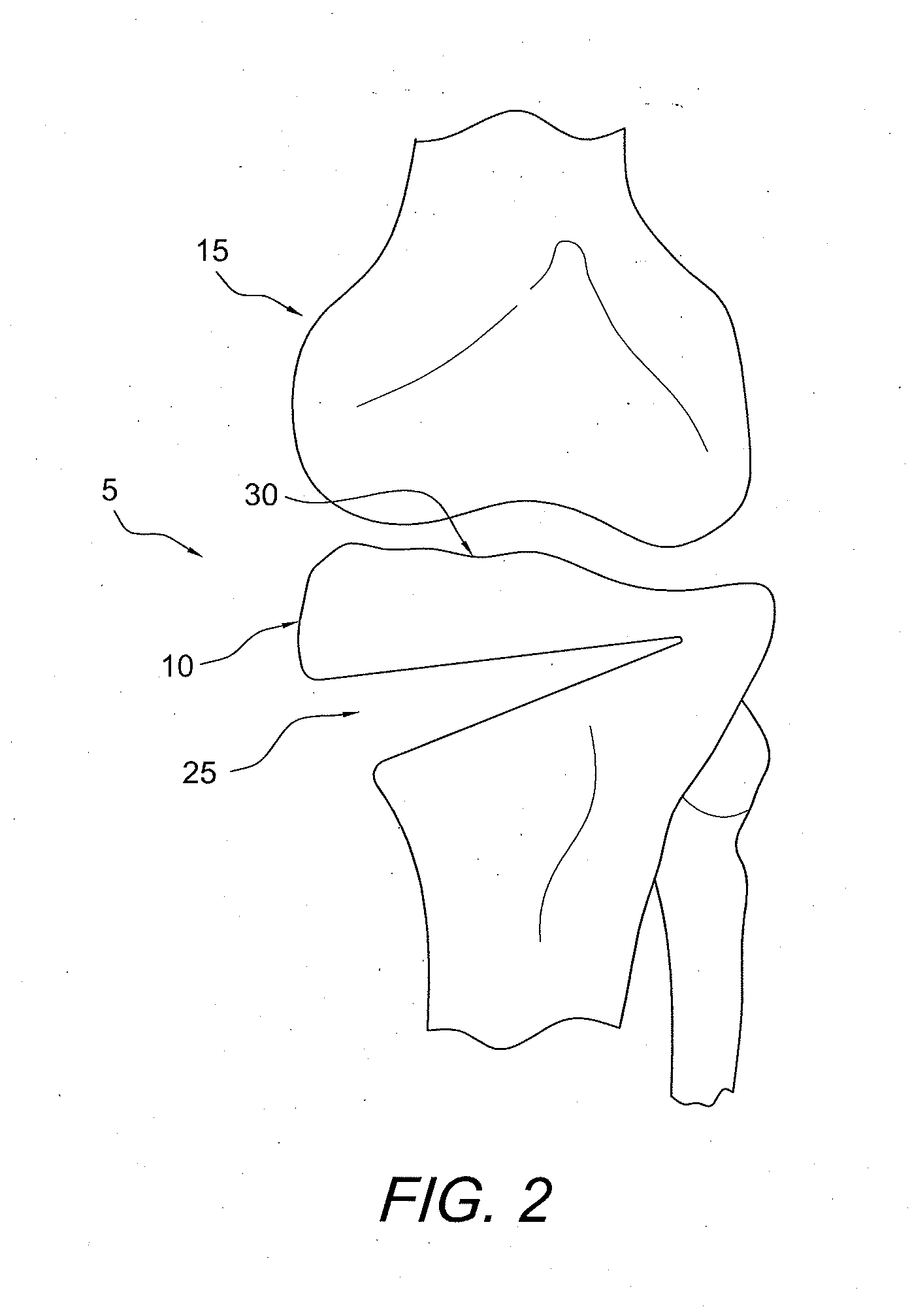 Method and apparatus for performing an open wedge, high tibial osteotomy