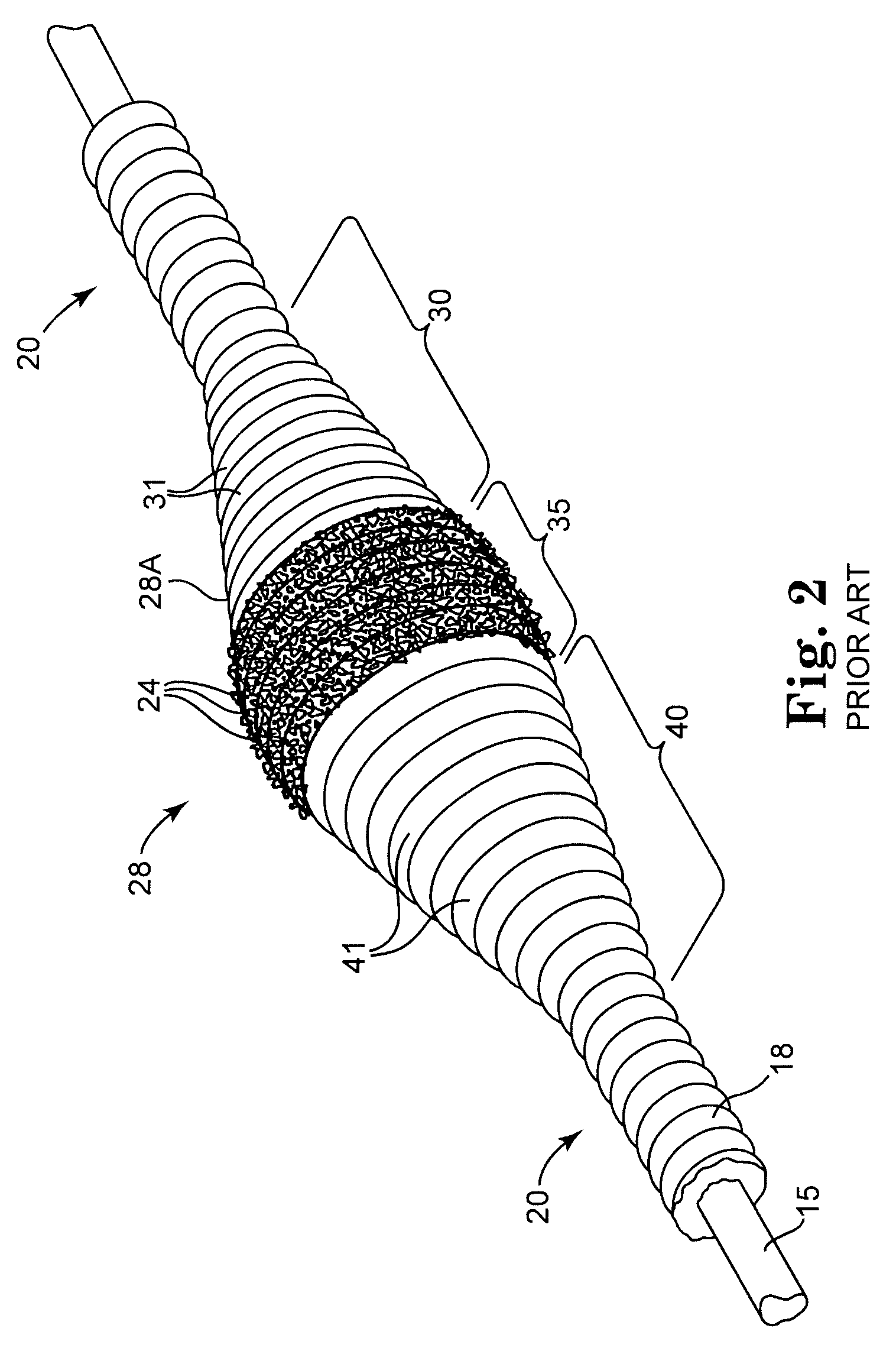 Method and apparatus for increasing rotational amplitude of abrasive element on high-speed rotational atherectomy device