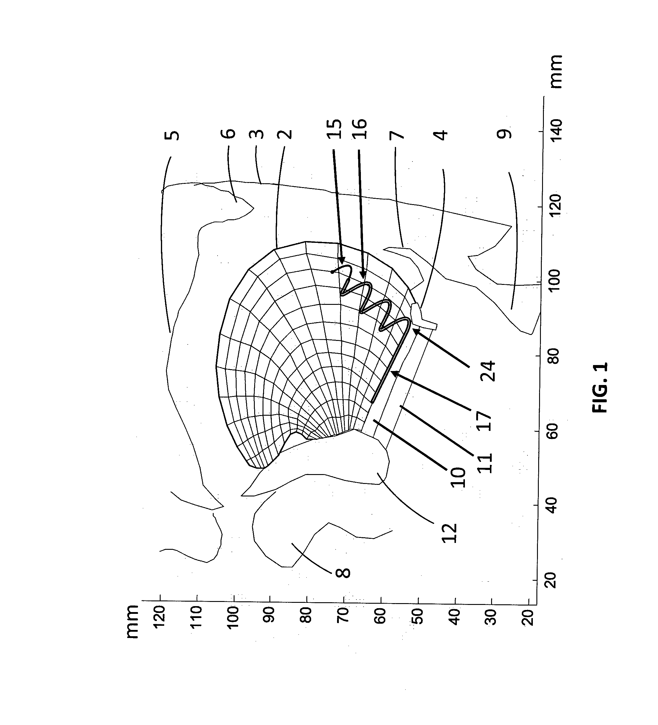 Tongue deformation implant