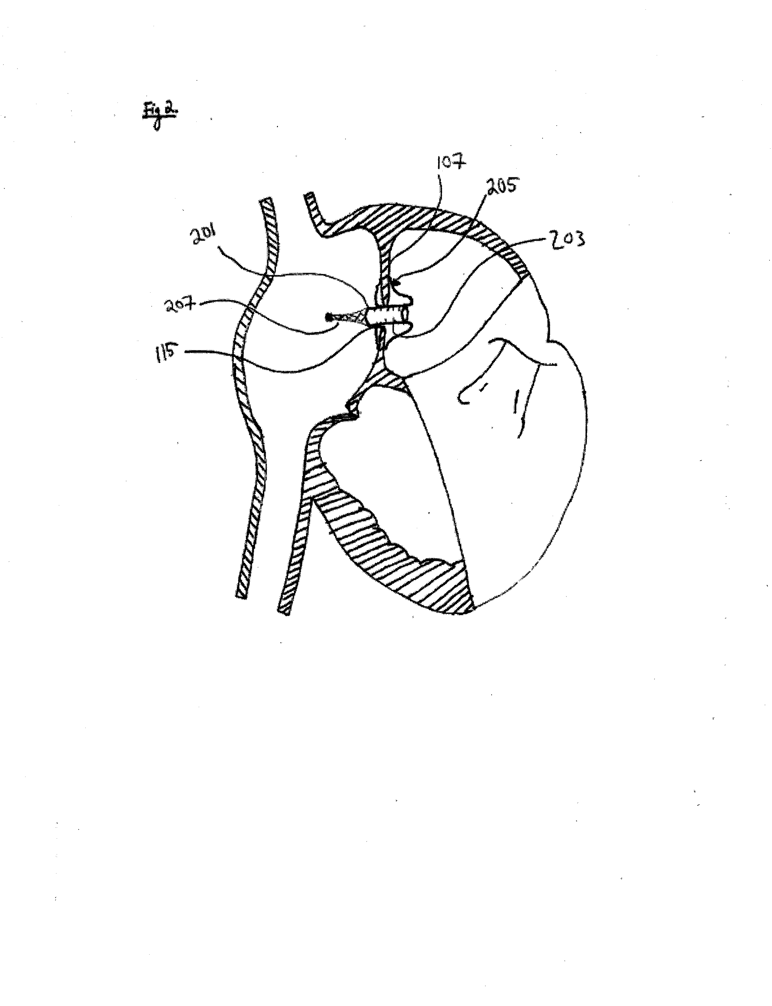 Methods, systems, and devices for resizable intra-atrial shunts