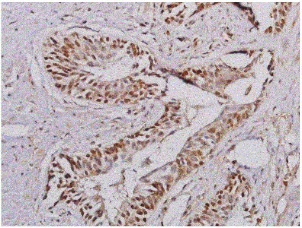 Reagent for prostatic cancer diagnosis and prognostic immunohistochemical detection