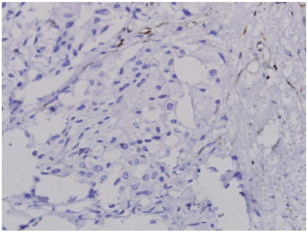 Reagent for prostatic cancer diagnosis and prognostic immunohistochemical detection