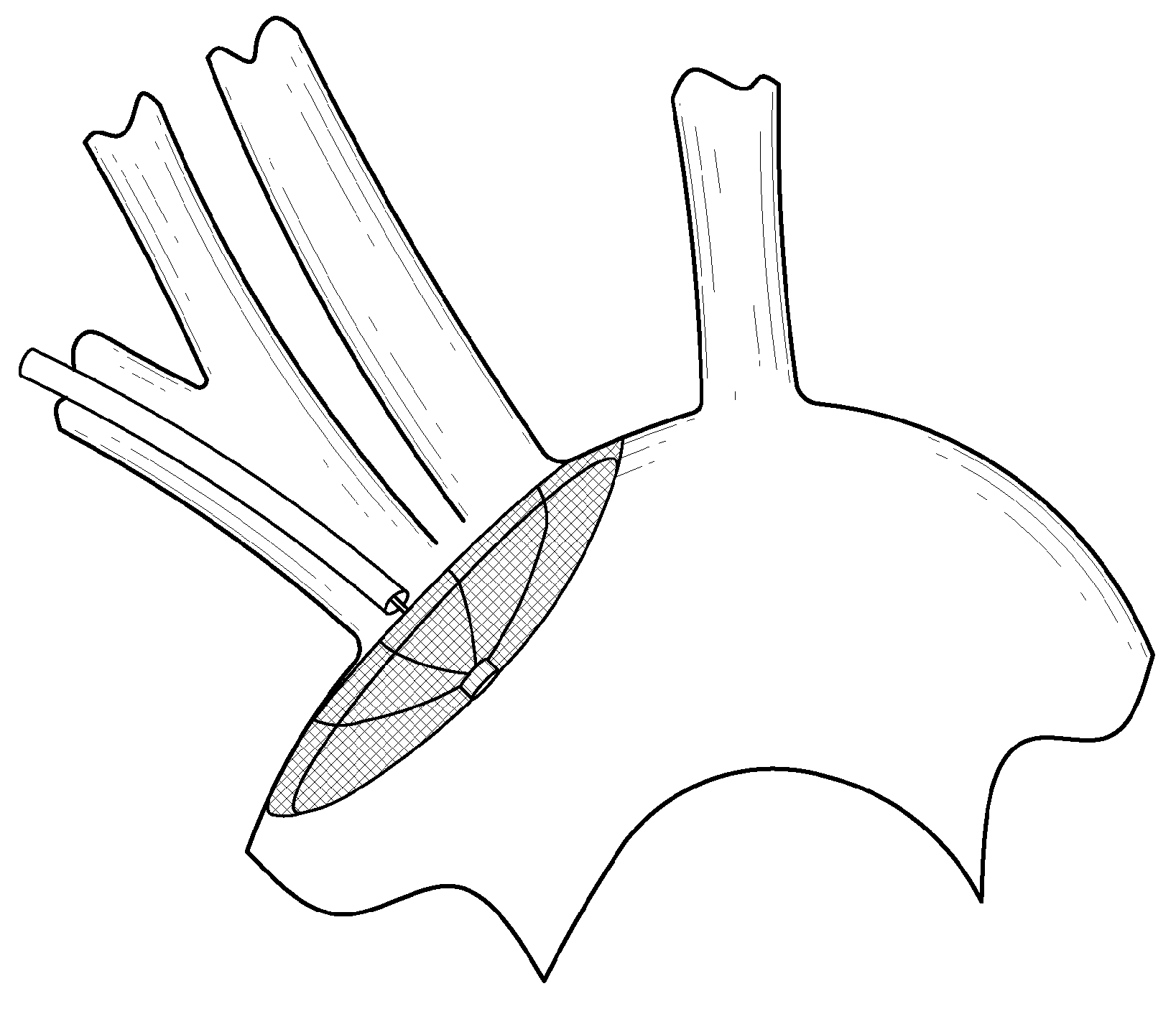 Embolic Protection Device and Method of Use