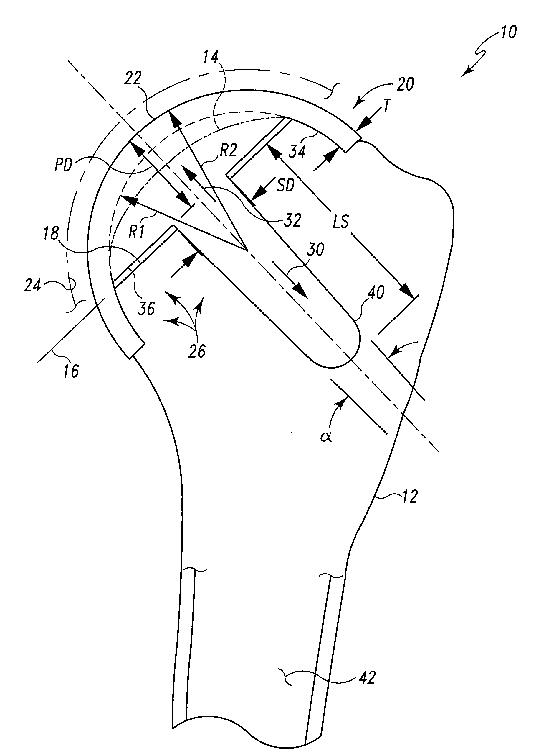 Articulating Surface Replacement Prosthesis