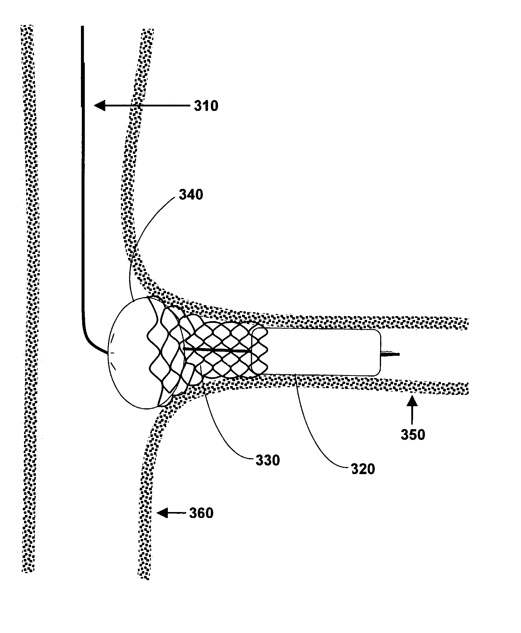 Method and system for treating an ostium of a side-branch vessel