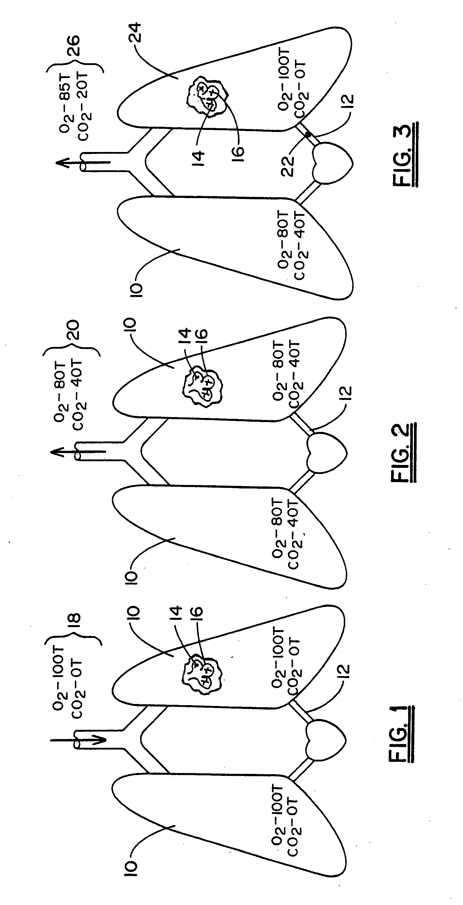 Non-invasive device and method for the diagnosis of pulmonary vascular occlusions