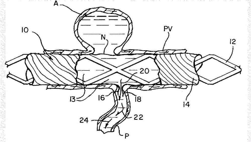 Improved modifiable occlusion device