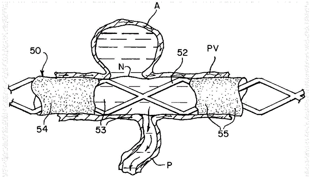 Improved modifiable occlusion device
