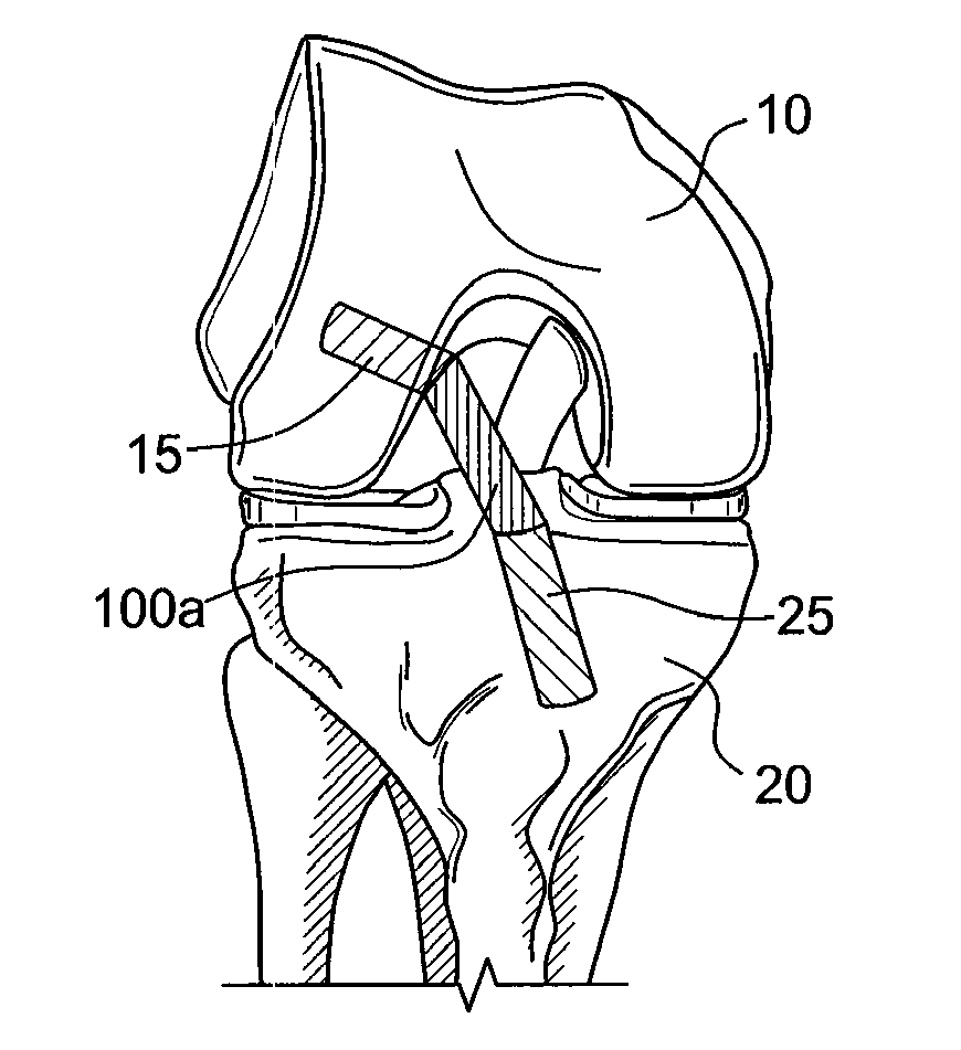 Methods and systems for forming unicompartmental and unicondylar knee resurfacing in conjunction with cruciate ligament replacement concomitantly