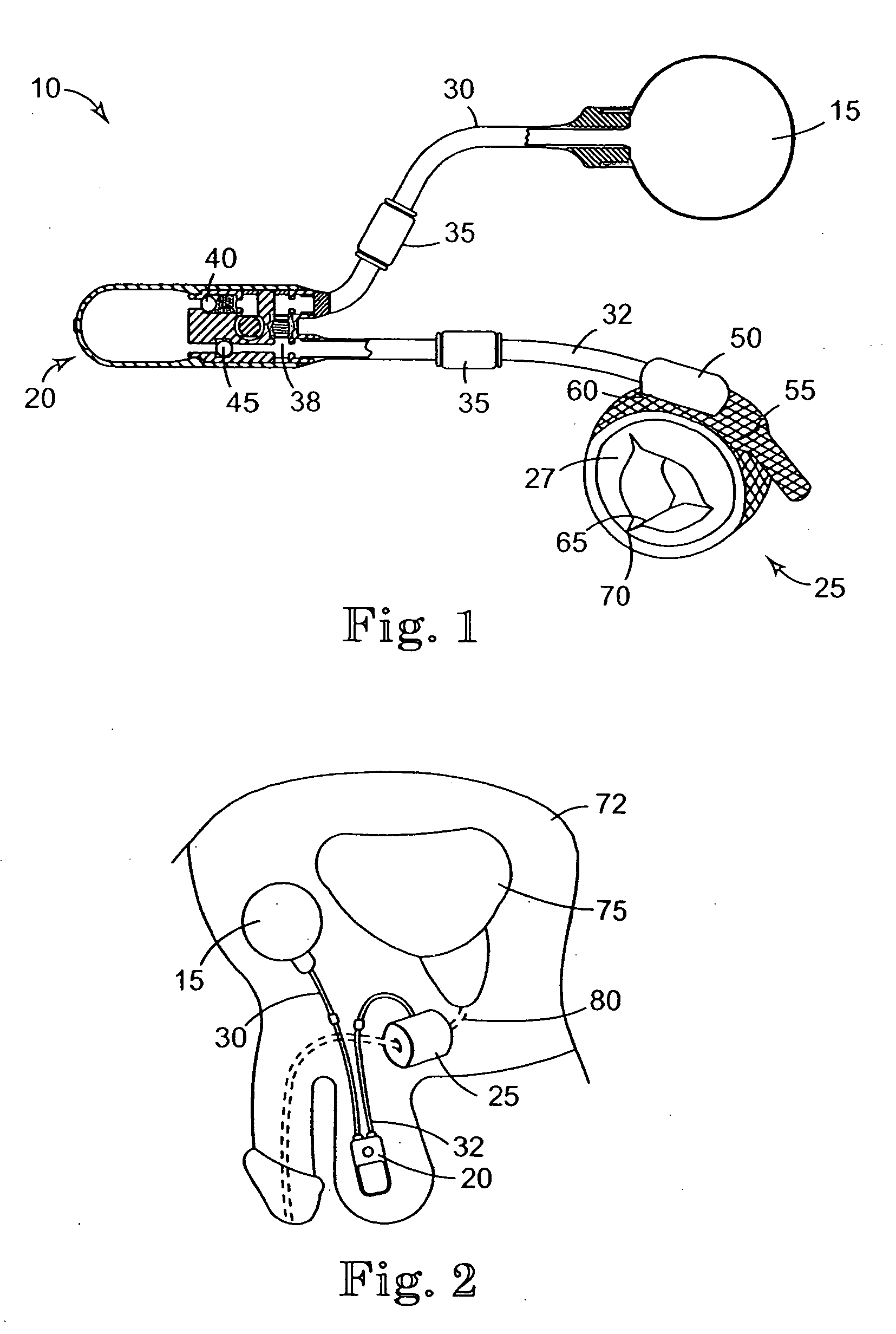 Parylene coated components for artificial sphincters
