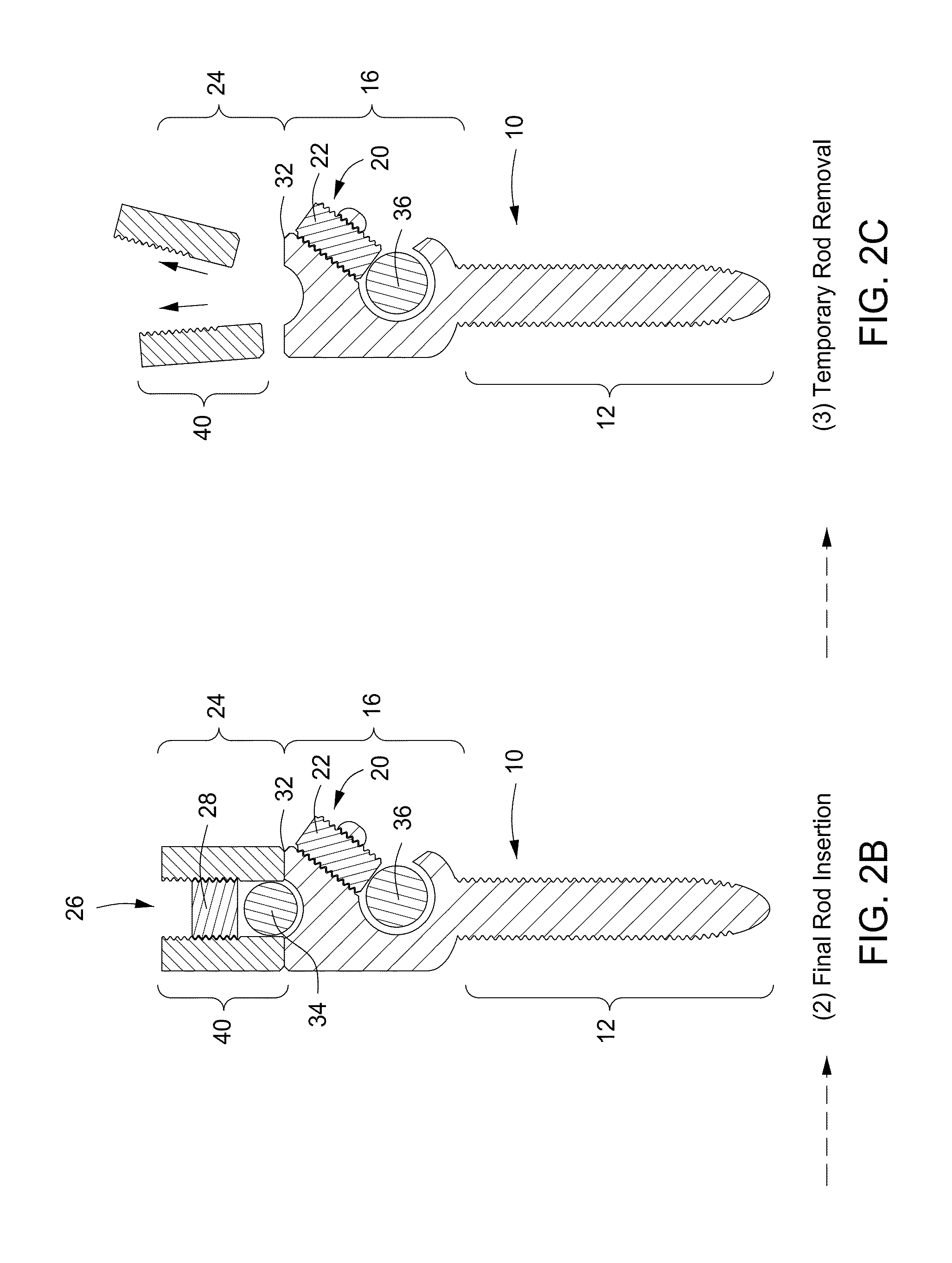 Pedicle screw having a removable rod coupling