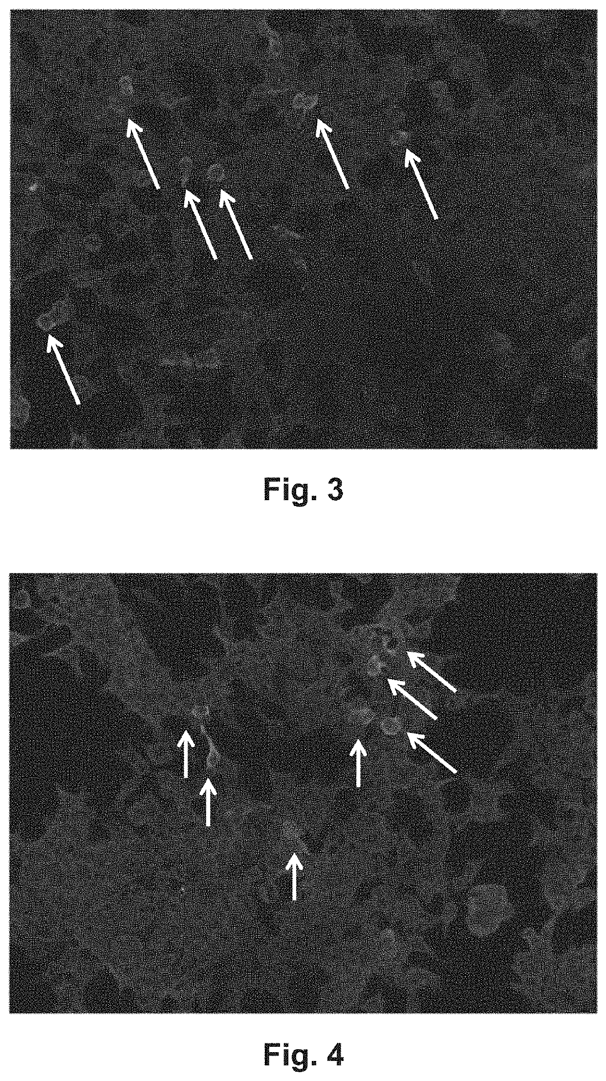Method and reagents for diagnosing Membranous Nephropathy