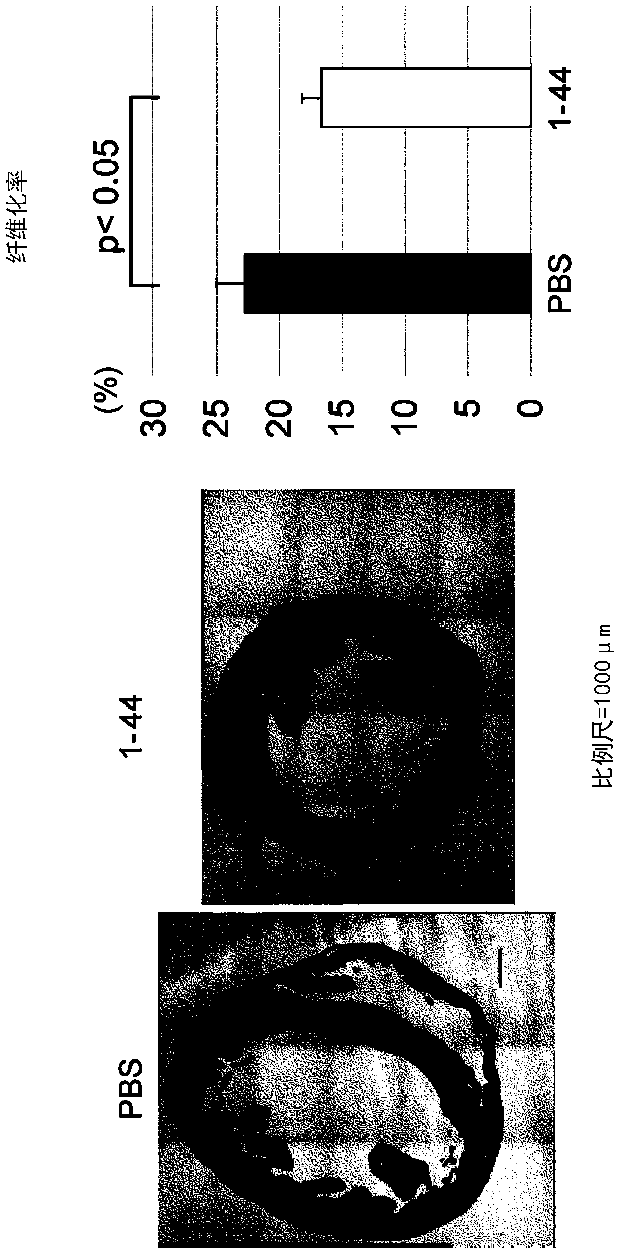 Therapeutic agent for cardiomyopathy, old myocardial infarction and chronic heart failure