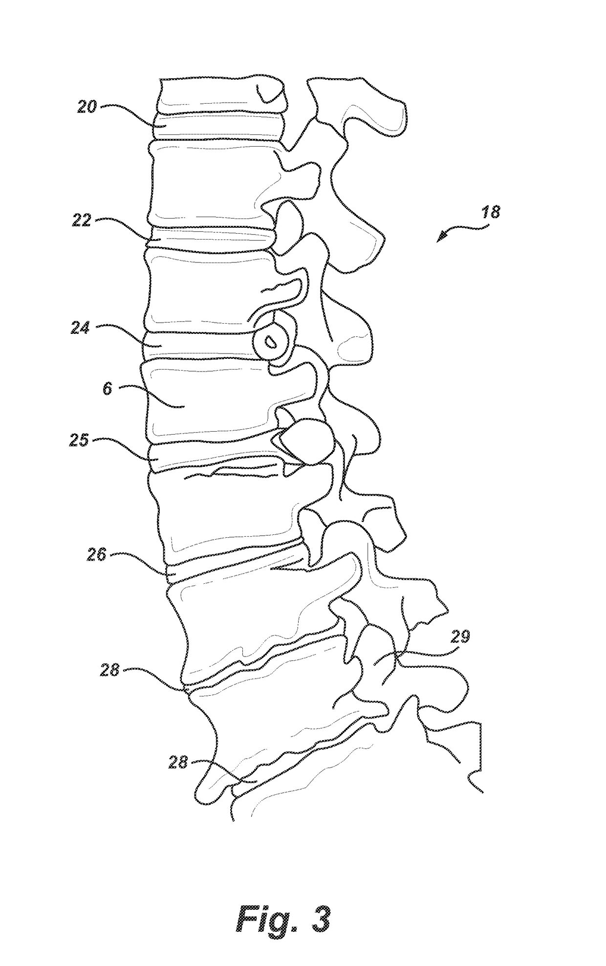 Systems and Methods for Patient-Specific Total Disc Replacement