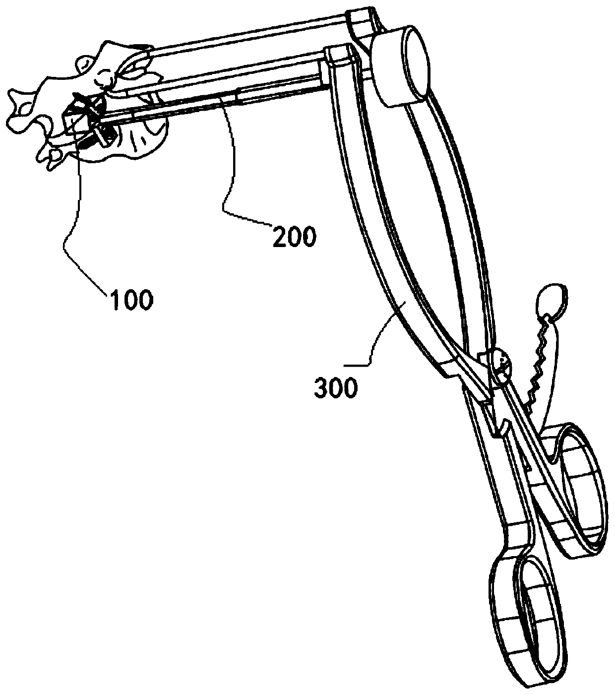 Transoral anterior atlantoaxial lateral mass embolia fusion cage system and using method thereof