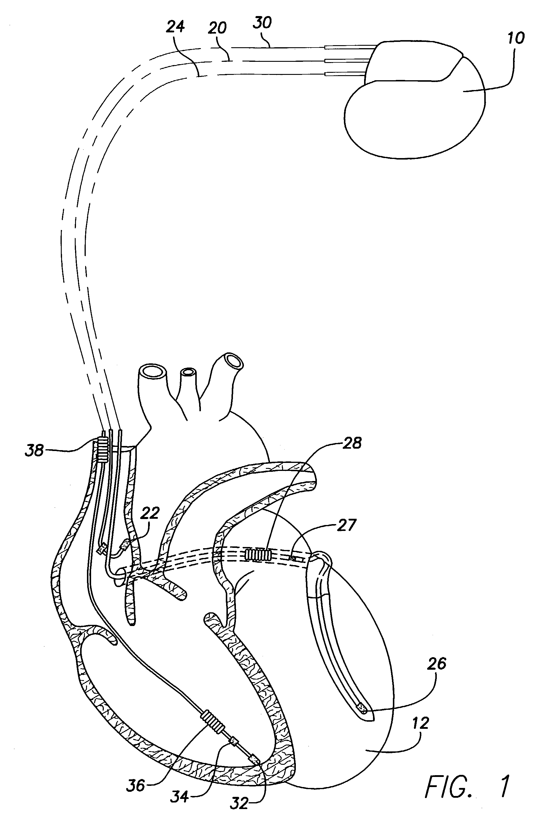 System and method for monitoring cardiac function via cardiac sounds using an implantable cardiac stimulation device