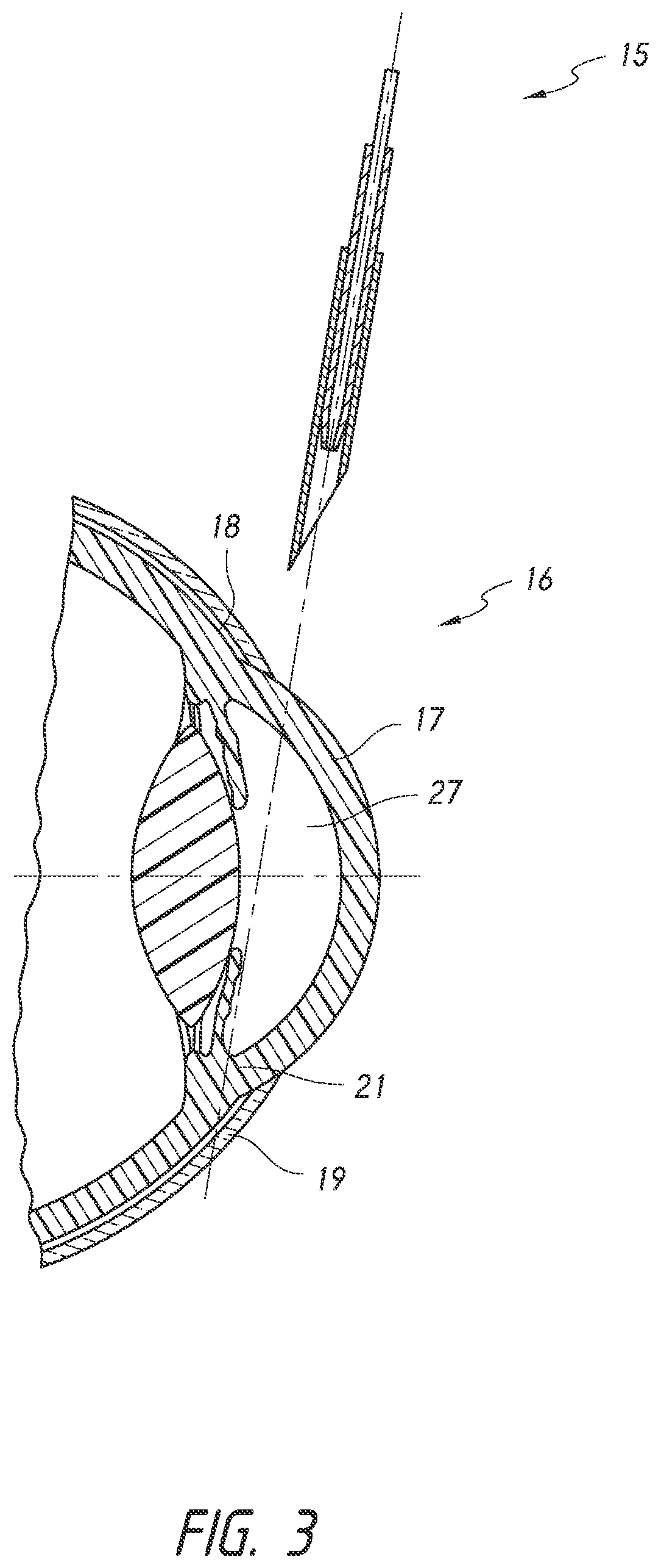 Methods for implanting intraocular shunts