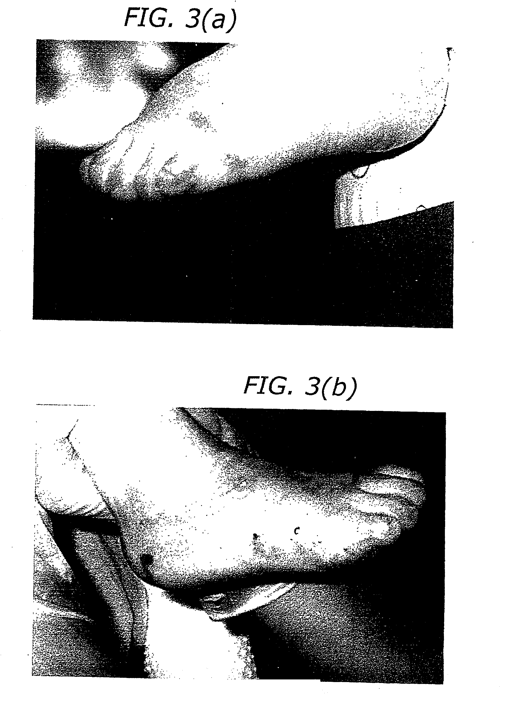 Methods for treatment of inflammatory diseases
