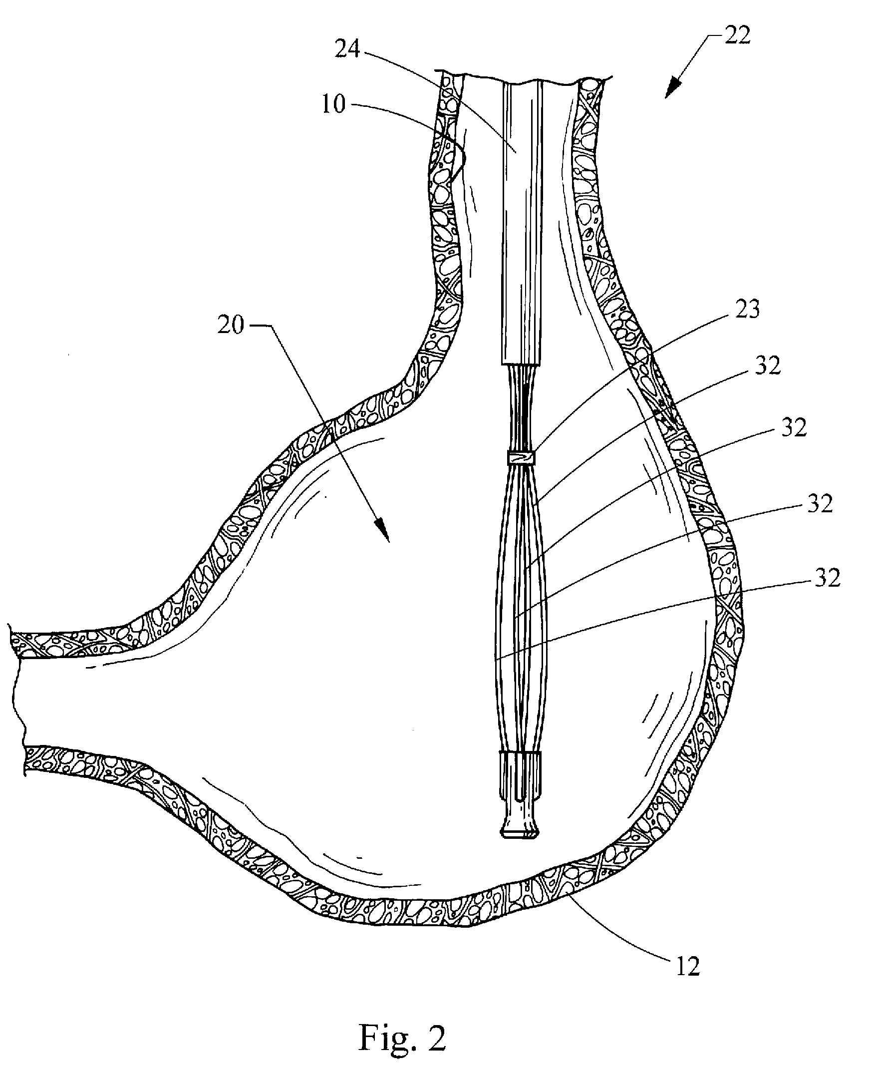 Medical devices, systems and methods for closing perforations