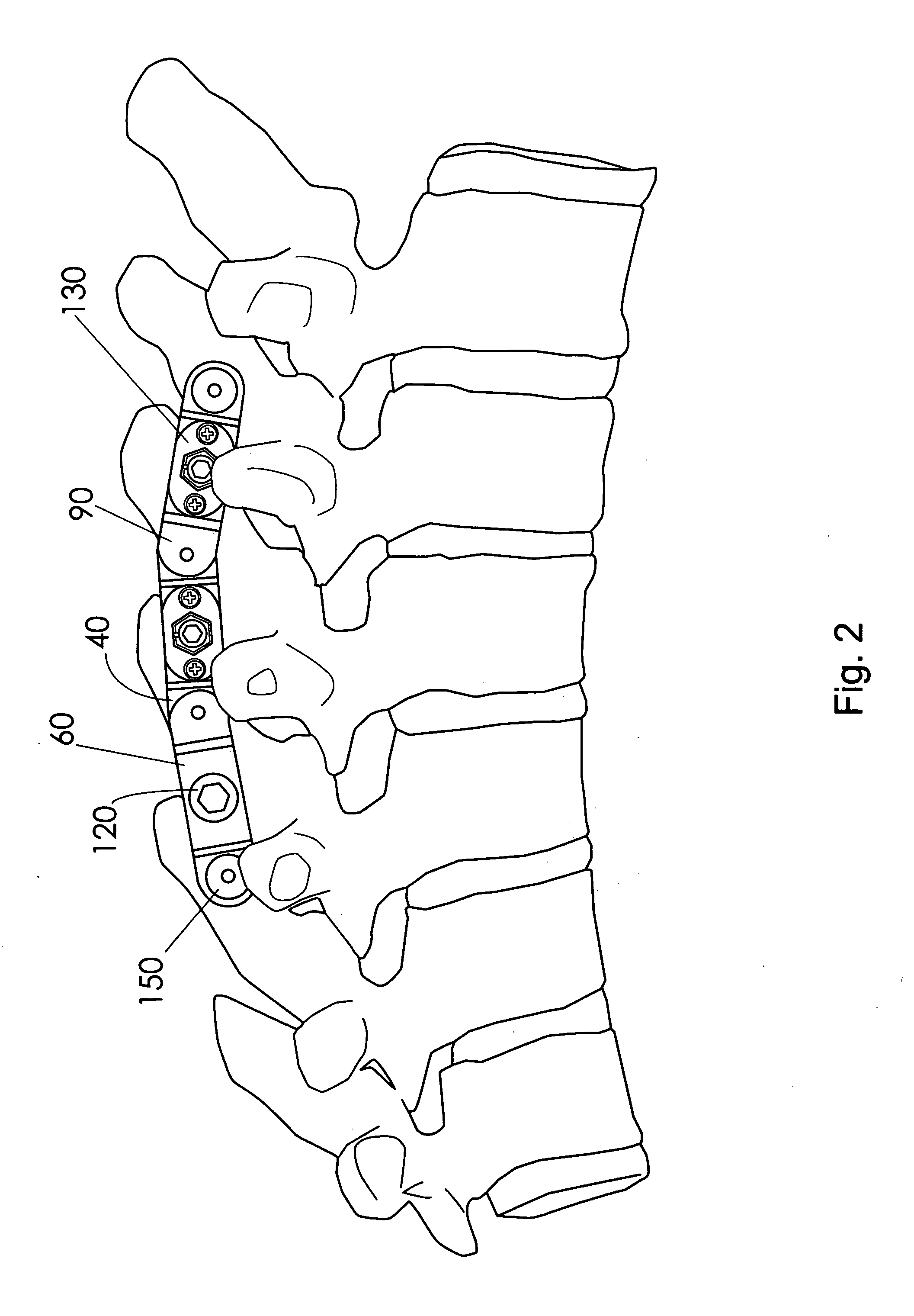Spinous process stabilization device and method