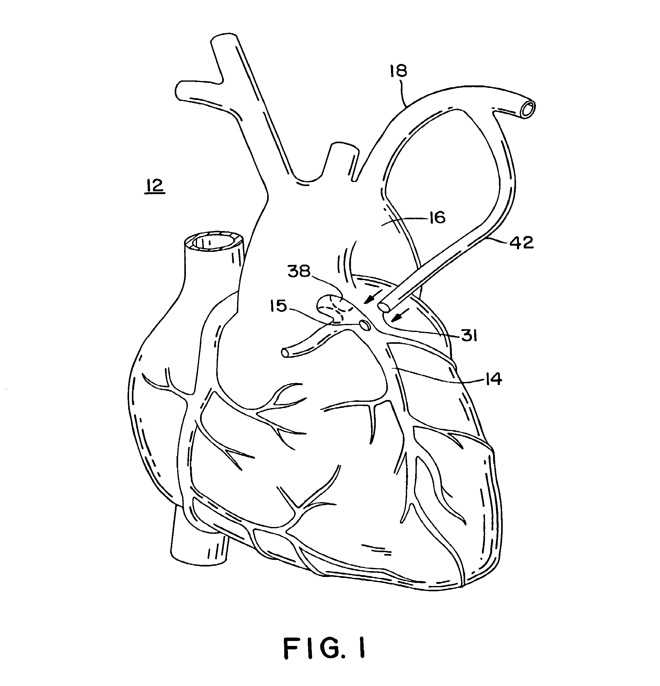 Methods and apparatus for making precise incisions in body vessels