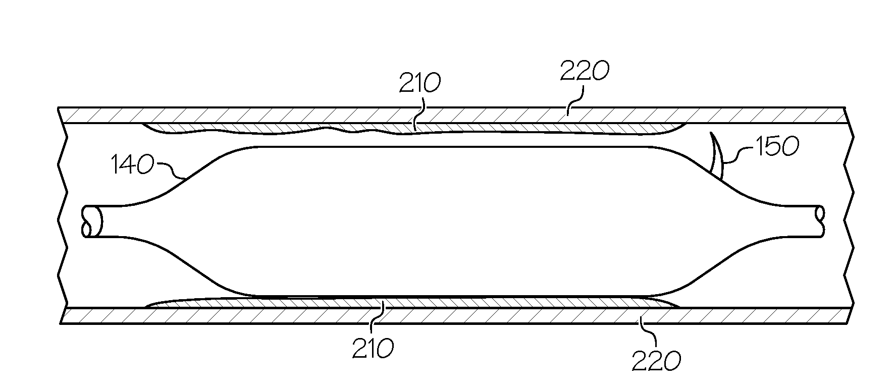 Intravascular catheter balloon device having a tool for atherectomy or an incising portion for atheromatous plaque scoring