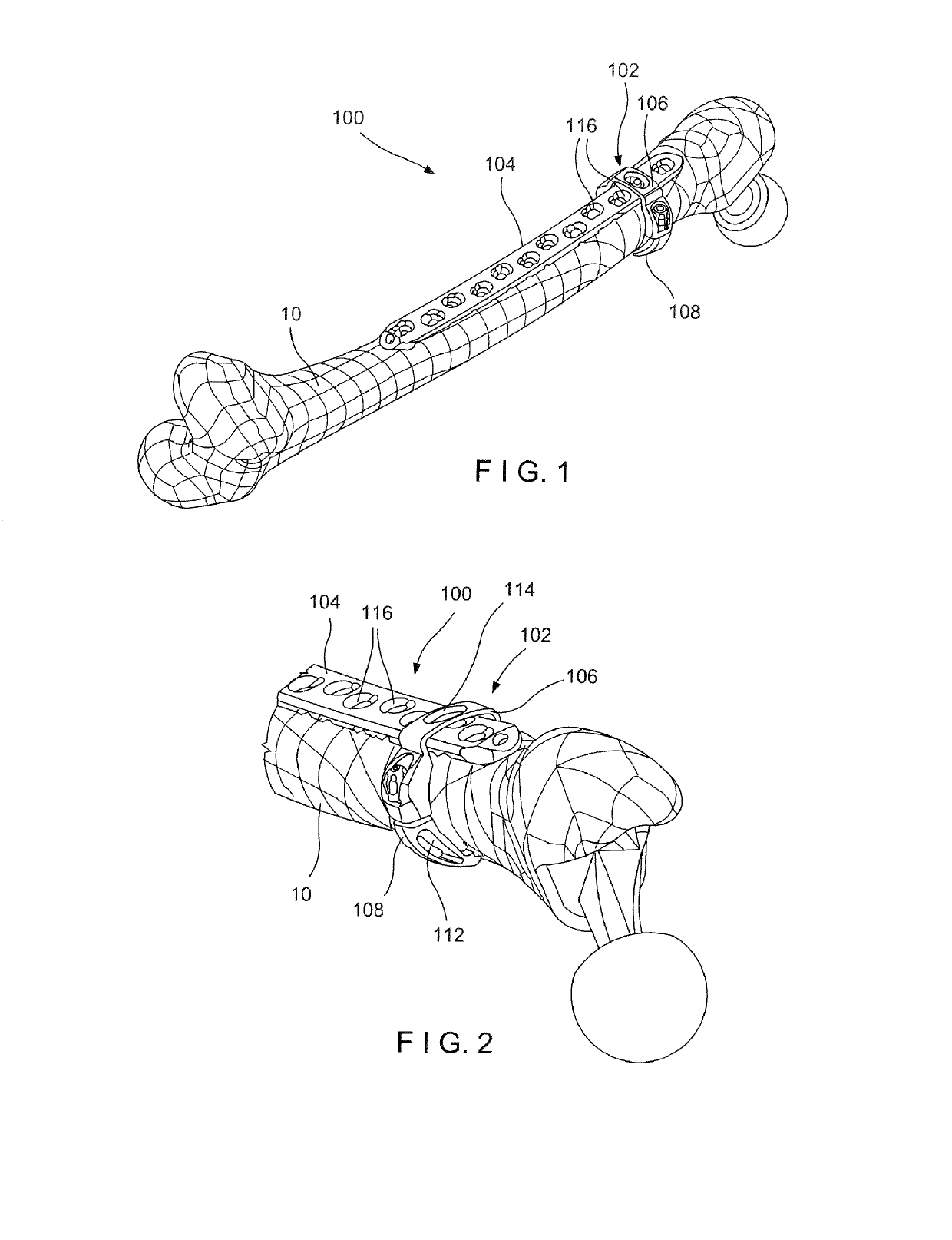 Bone Fracture Fixation Clamp with Bone Remodeling Adaptability