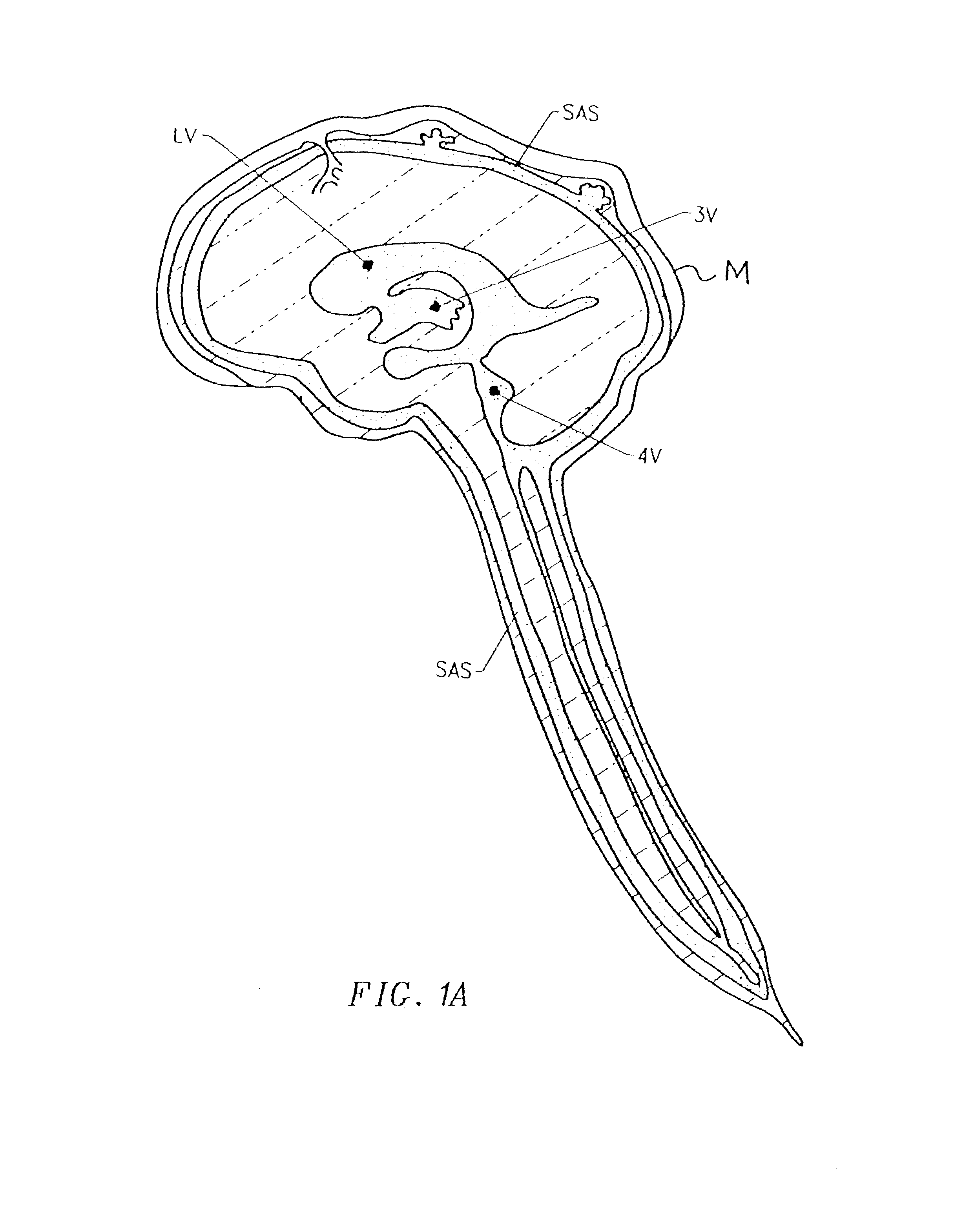 Methods for the treatment of a normal pressure hydrocephalus