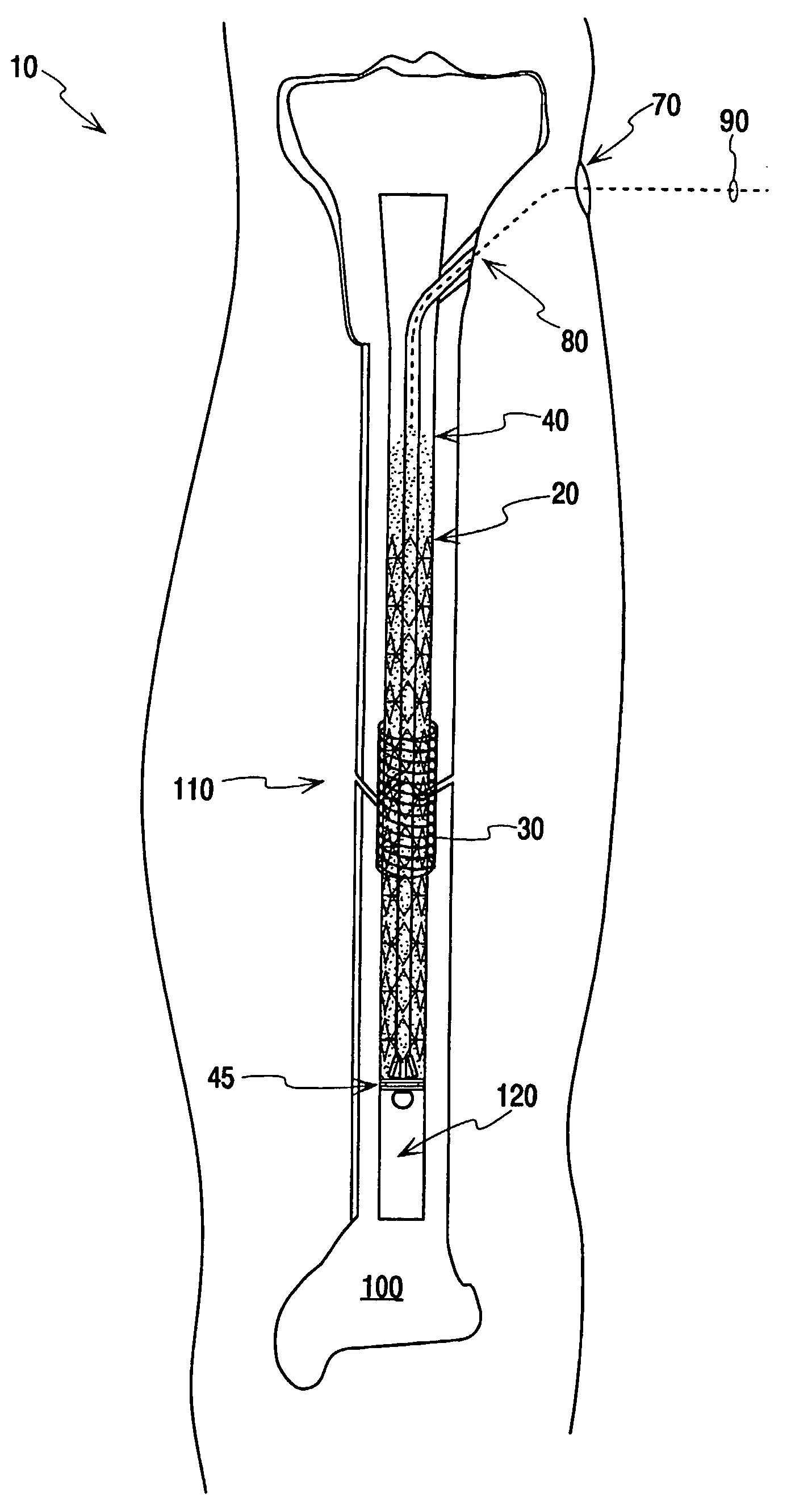 Fracture Fixation and Site Stabilization System