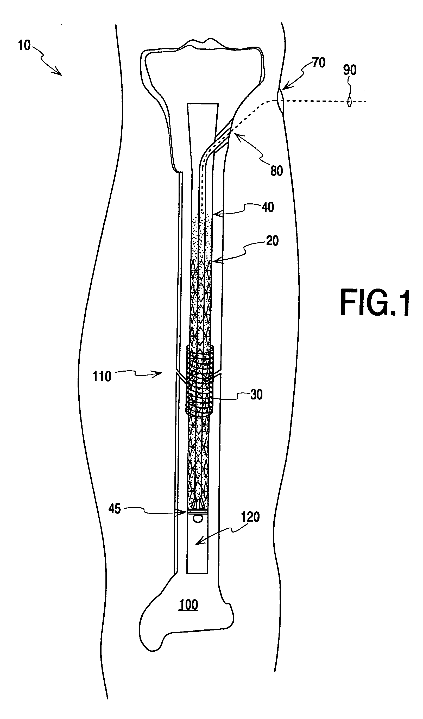 Fracture Fixation and Site Stabilization System