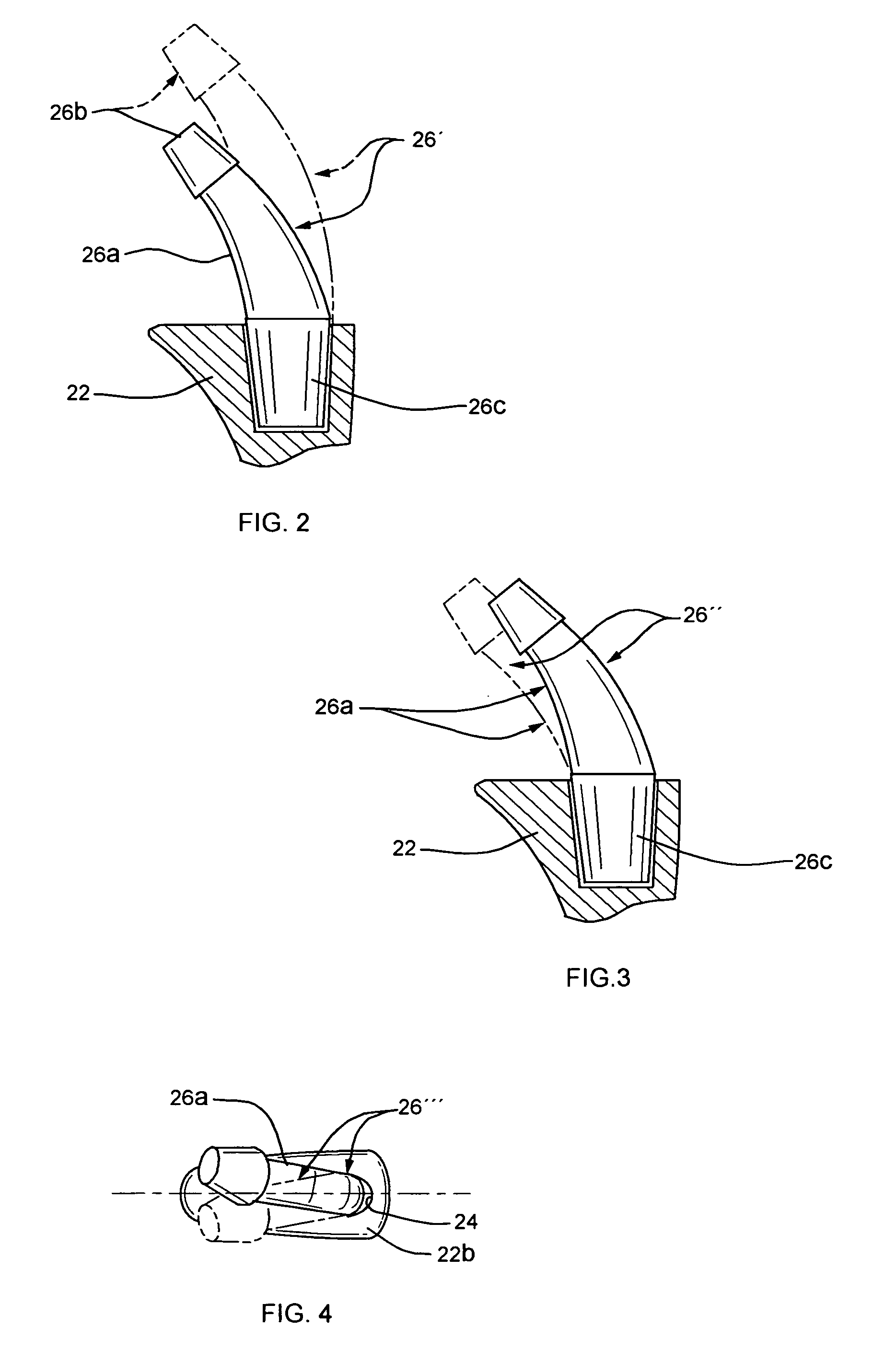 Modular femoral prosthesis with on-axis junction
