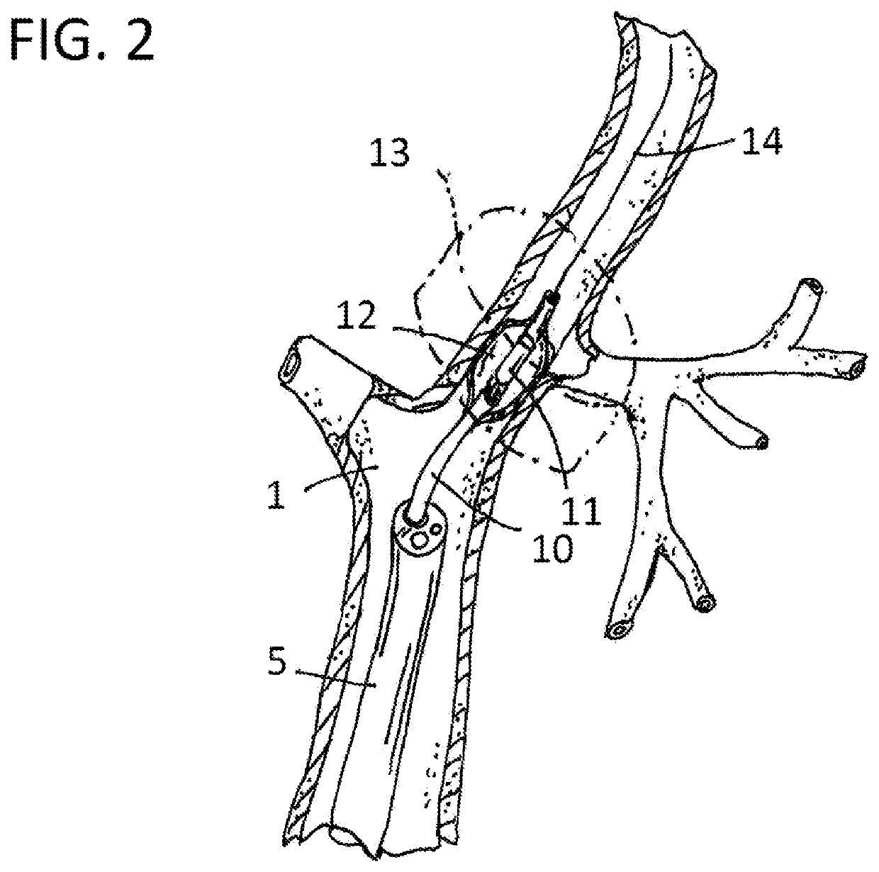 Method and apparatus for performance of thermal bronchioplasty to reduce COVID-19-induced respiratory distress and treat COVID-19-damaged distal lung regions