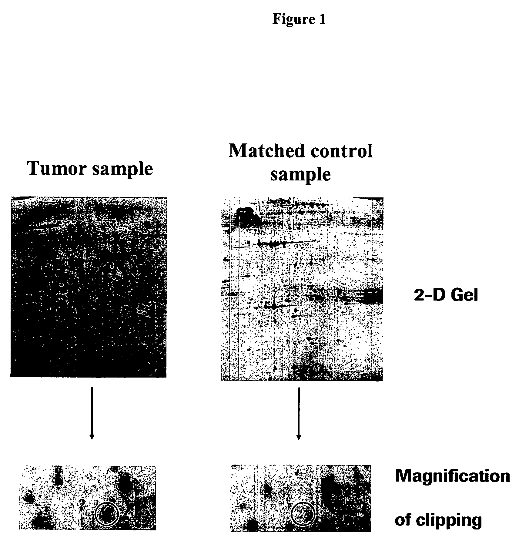 Cellular retinoic acid binding protein II as a marker for breast cancer