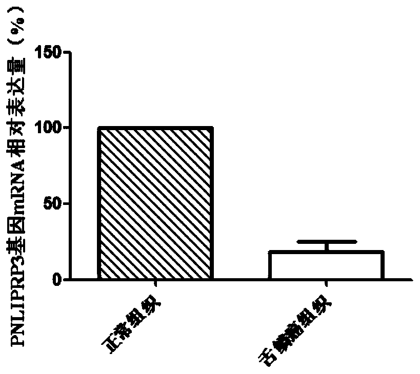 Application of pnliprp3 gene and its expression product in the diagnosis and treatment of squamous cell carcinoma of the tongue