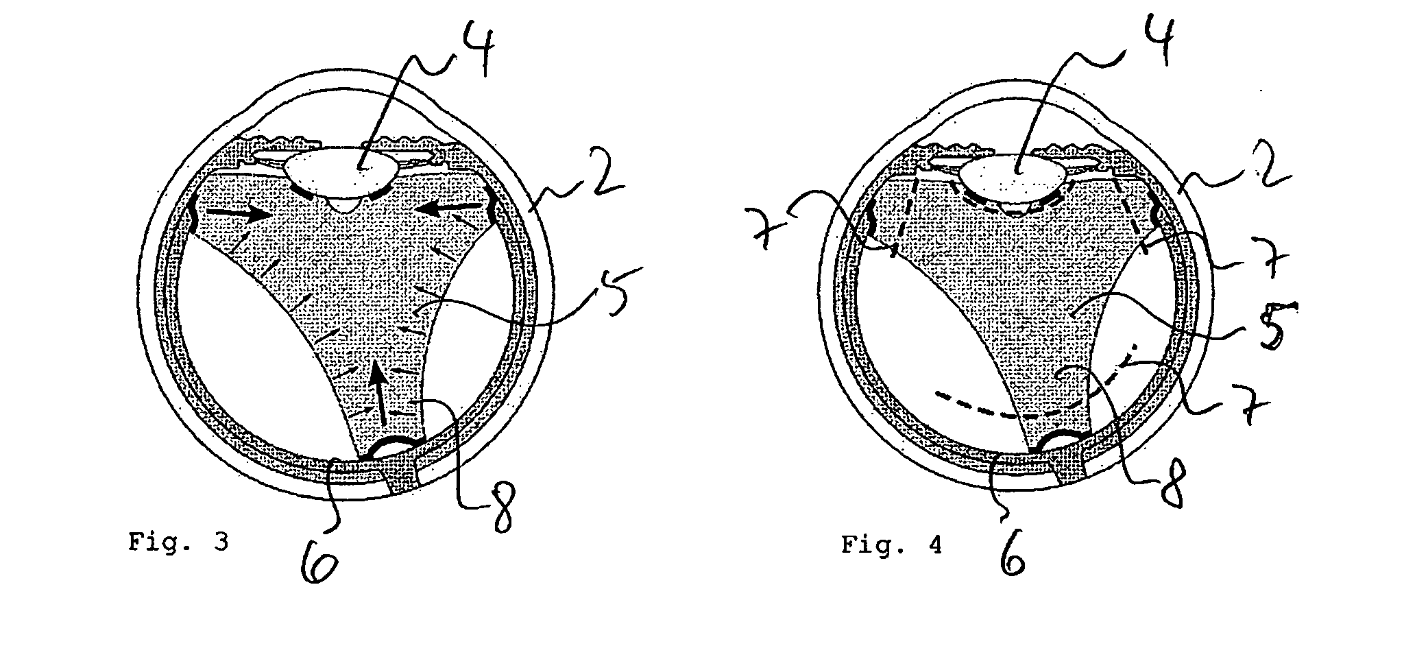 Device and method for vitreous humor surgery