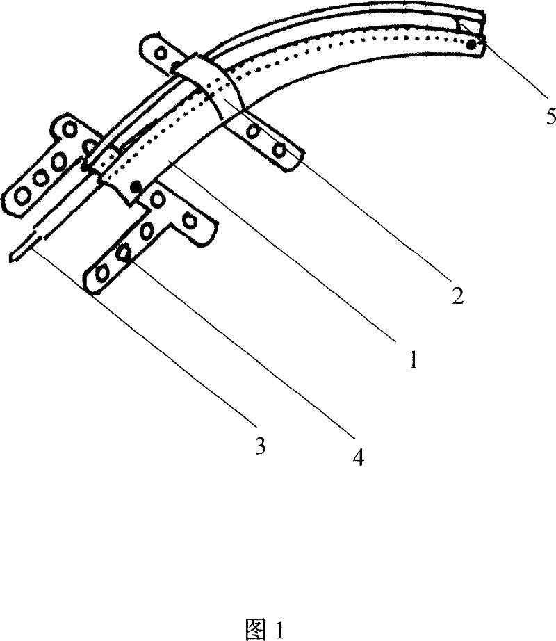 Zygoma internal arced distractor