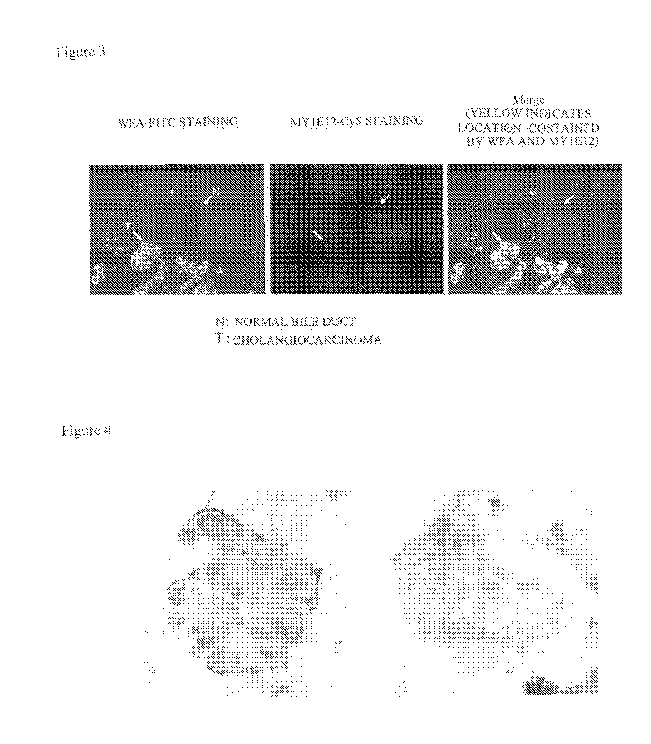 Method for detecting and distinguishing intrahepatic cholangiocarcinoma