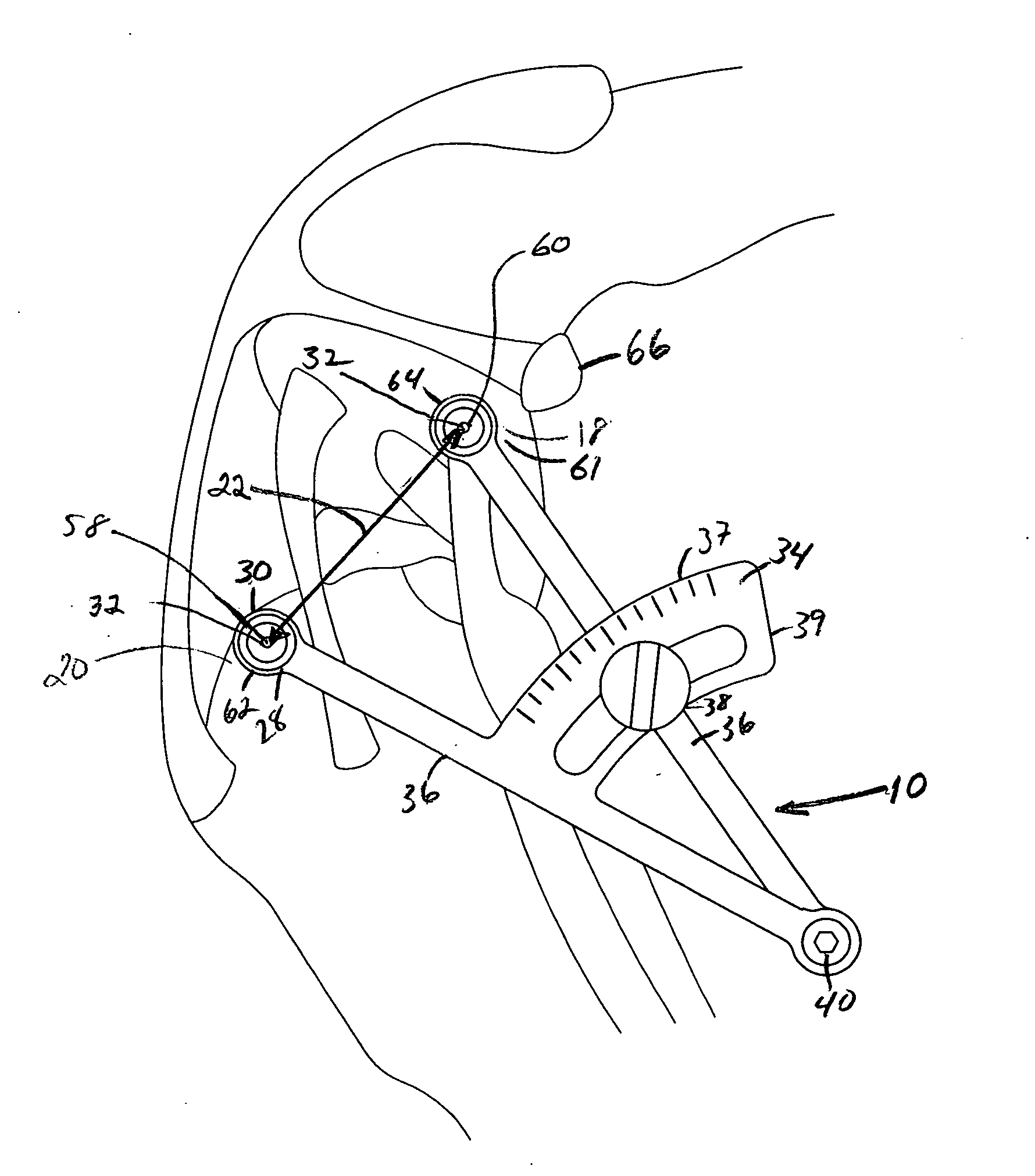 Extracapsular surgical procedure and surgical referencing instrument therefor