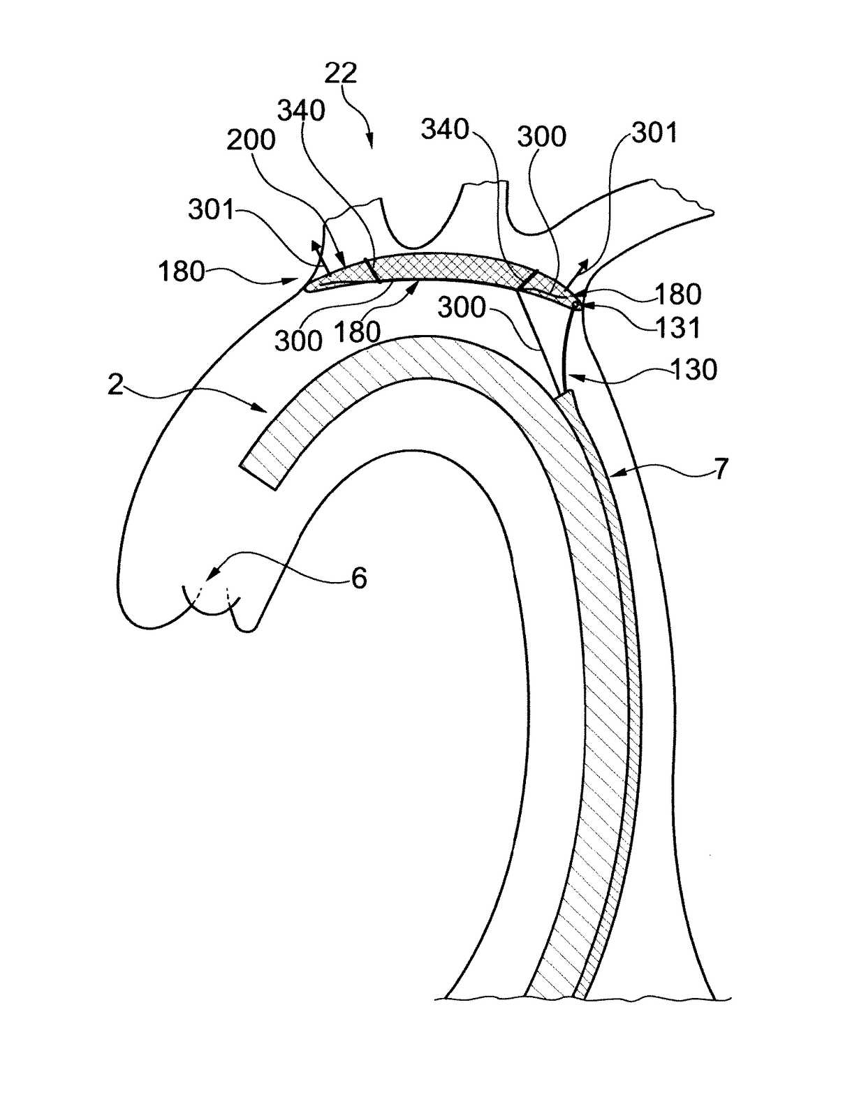 Embolic protection device and method