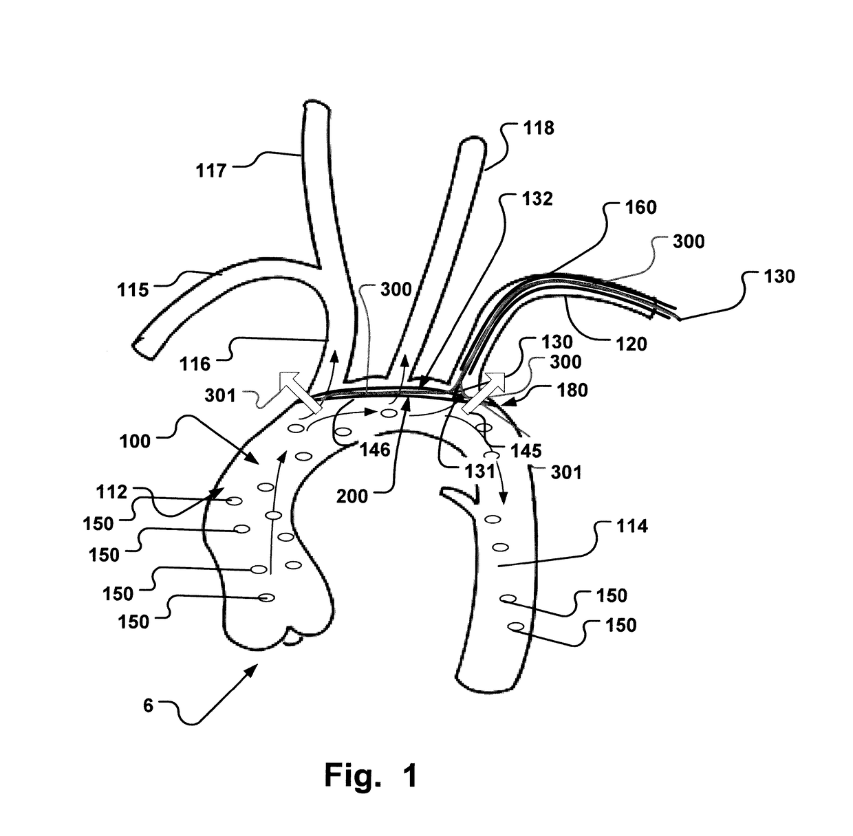 Embolic protection device and method