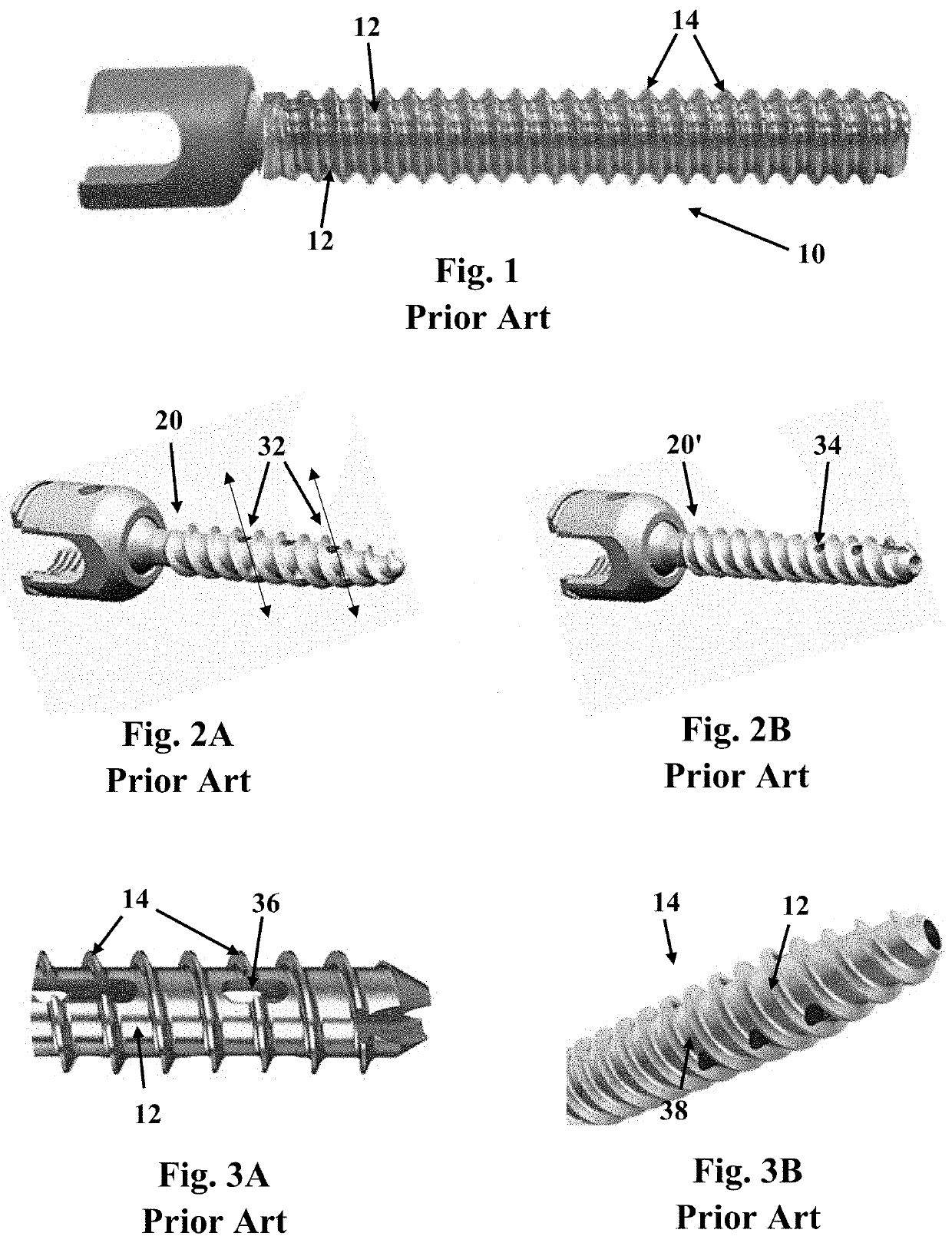 Fasteners and system for providing fasteners in bone