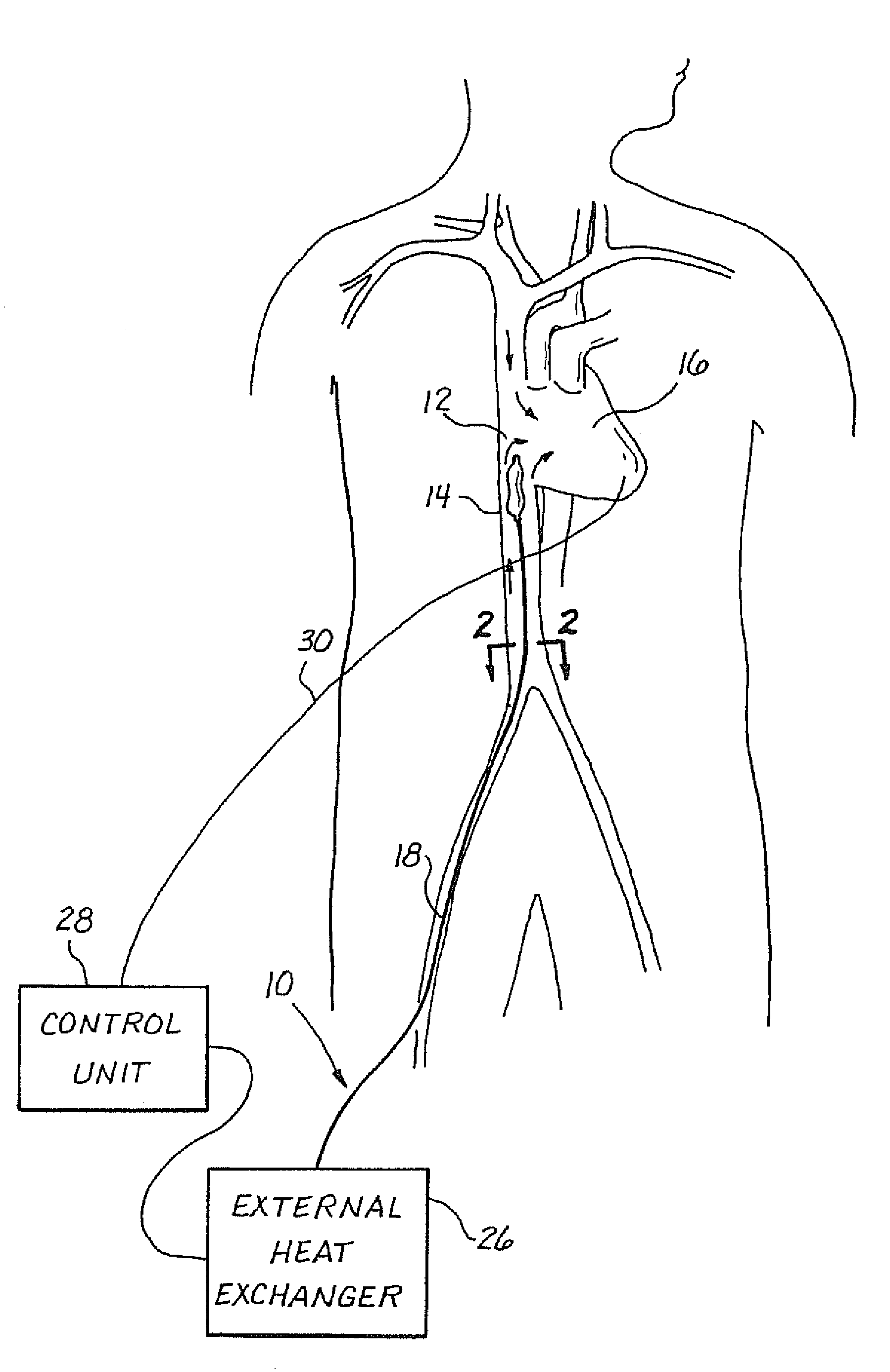 Method for reducing myocardial infarct by application of intravascular hypothermia