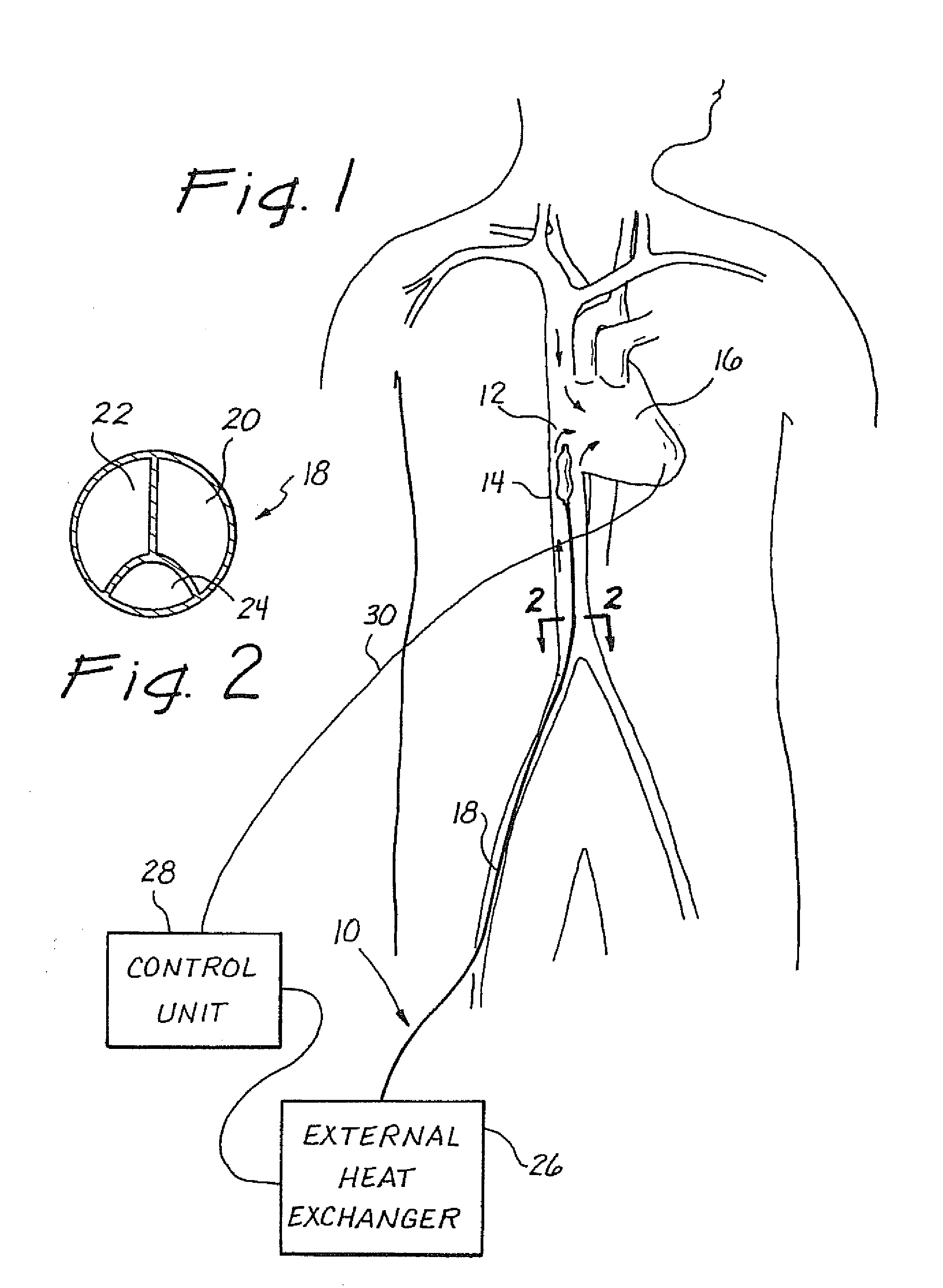 Method for reducing myocardial infarct by application of intravascular hypothermia